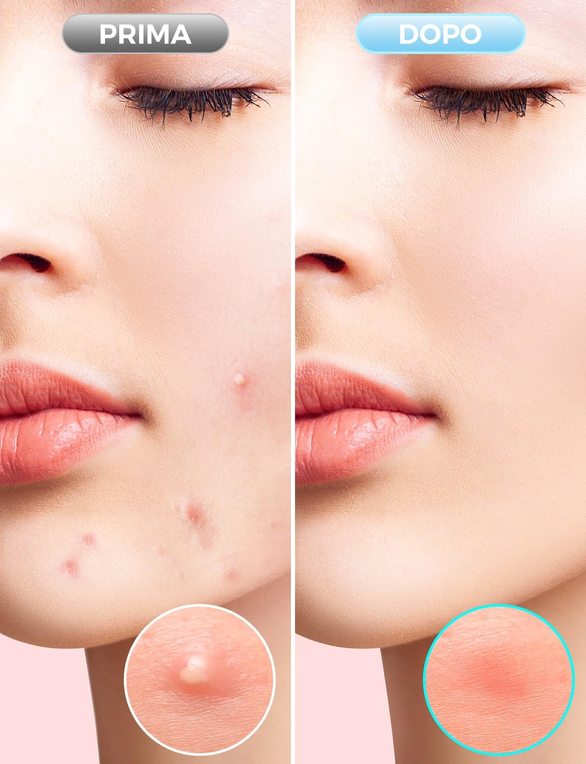 Detalle de Patch idrocolloidi invisibili per brufoli – 360 cerotti assorbenti, impermeabili e delicati