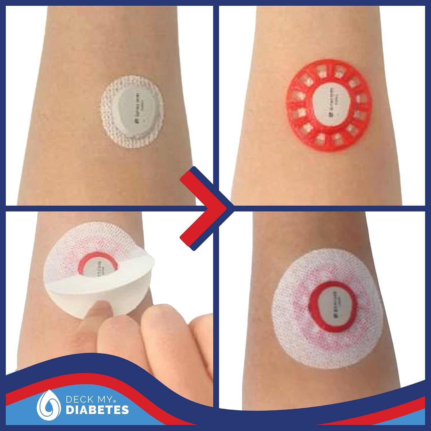 Detalle de Deck My Diabetes Dexcom G7 GripShield センサー保護カバー 柔軟TPU・再利用可能・クリスタルクリア