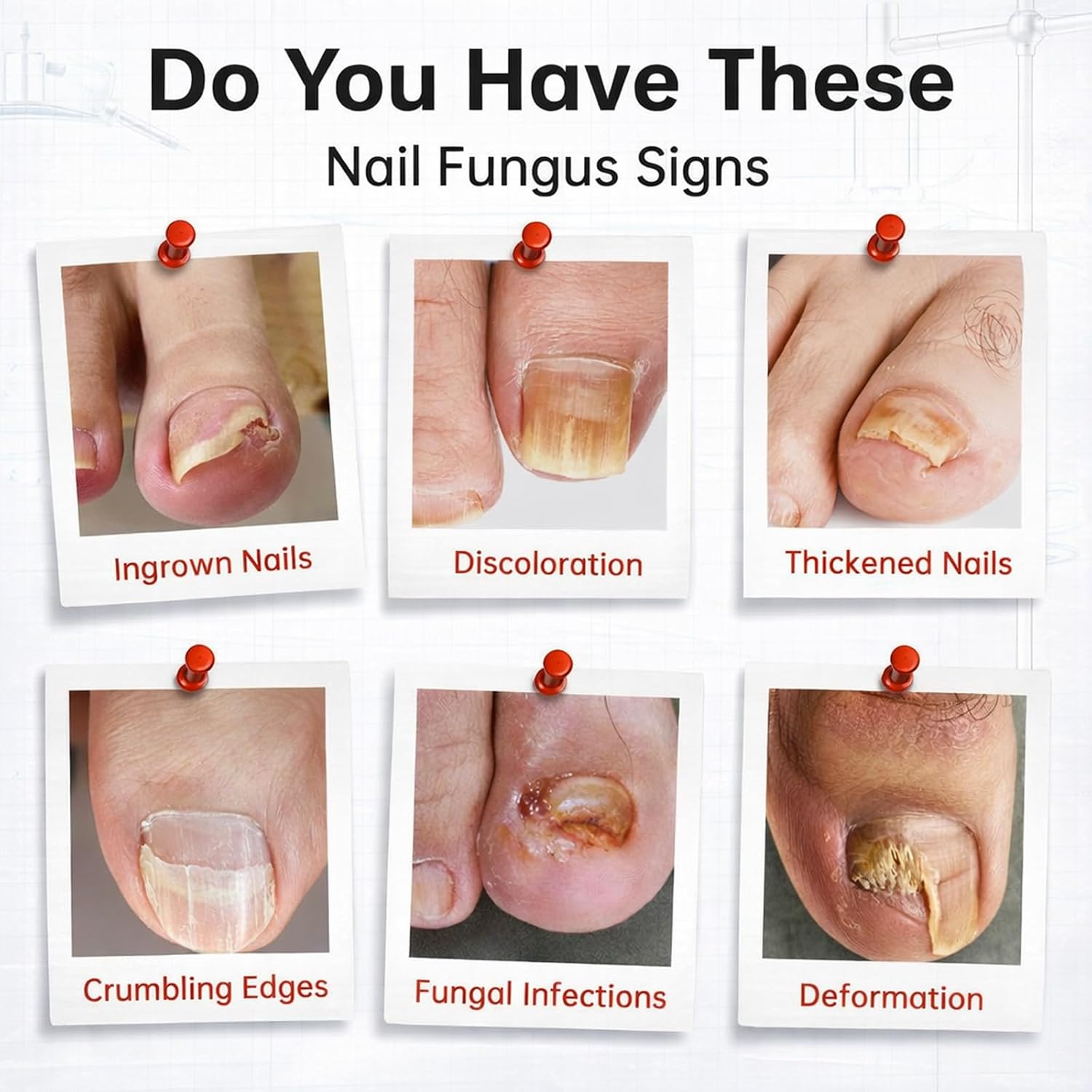 Thumbnail 1 de Toenail Fungus Treatment with 1% Tolnaftate
