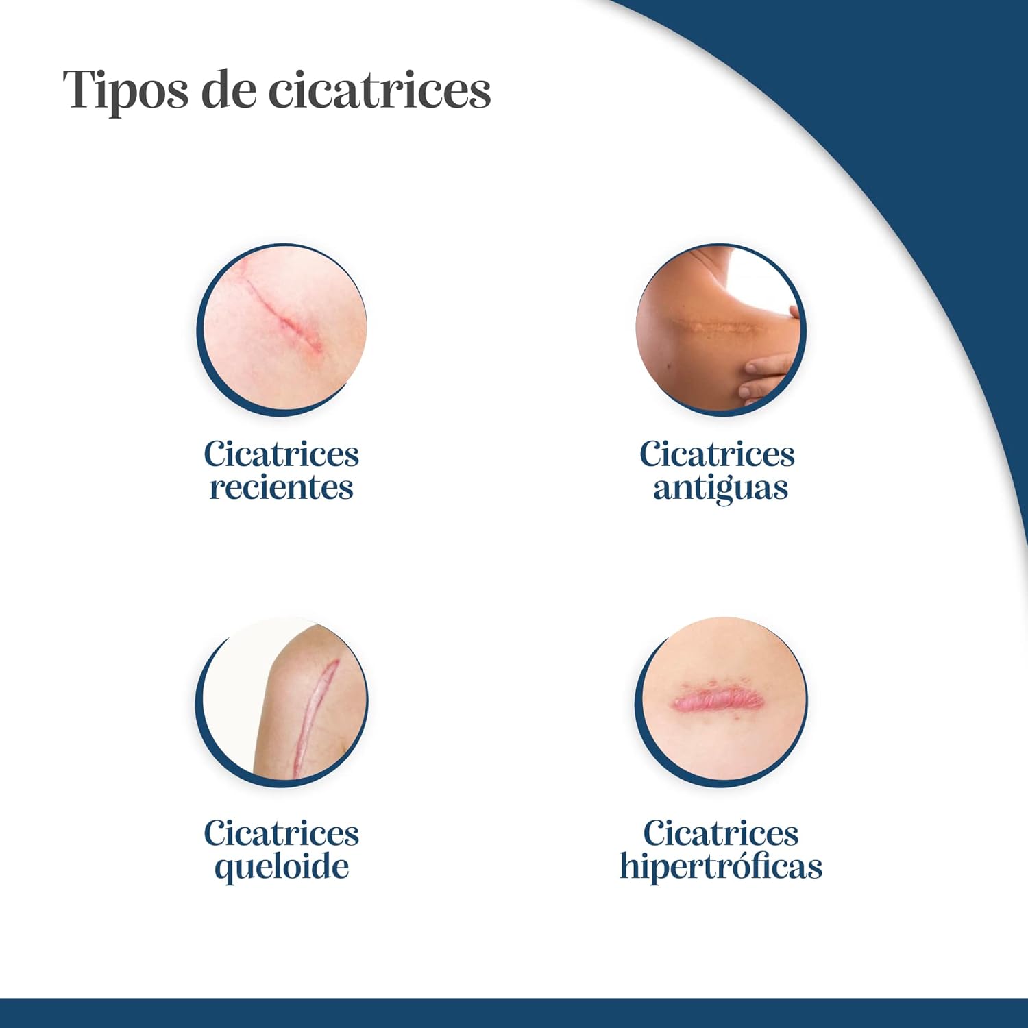 Thumbnail 3 de Trofolastin, Apósitos para Cicatrices Hipertróficas y Queloides 🩹