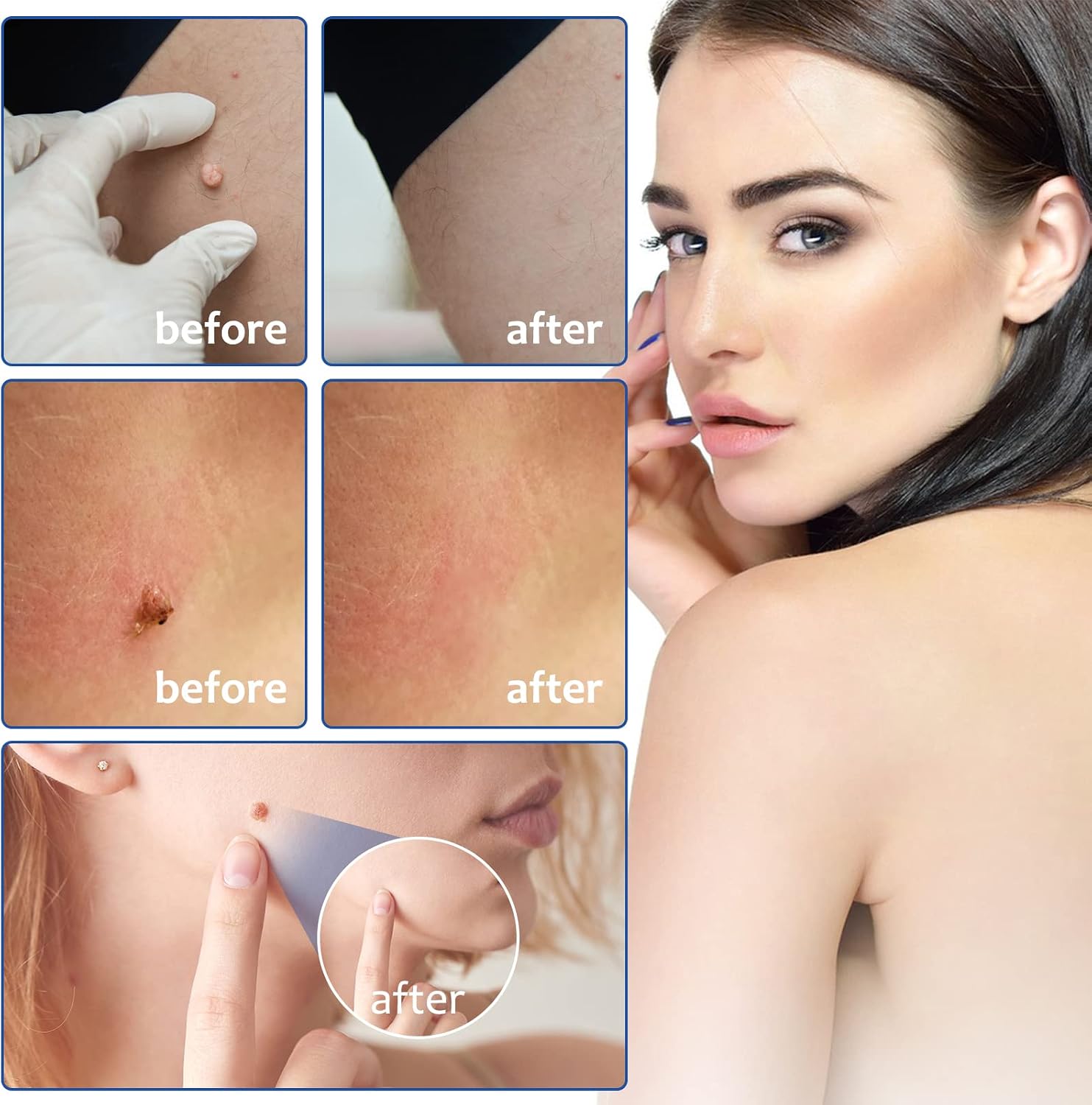 Thumbnail 2 de 2-in-1 Auto Skin Tag Removal Kit (Small to Large 1–9mm) — No Chemicals, No Burning