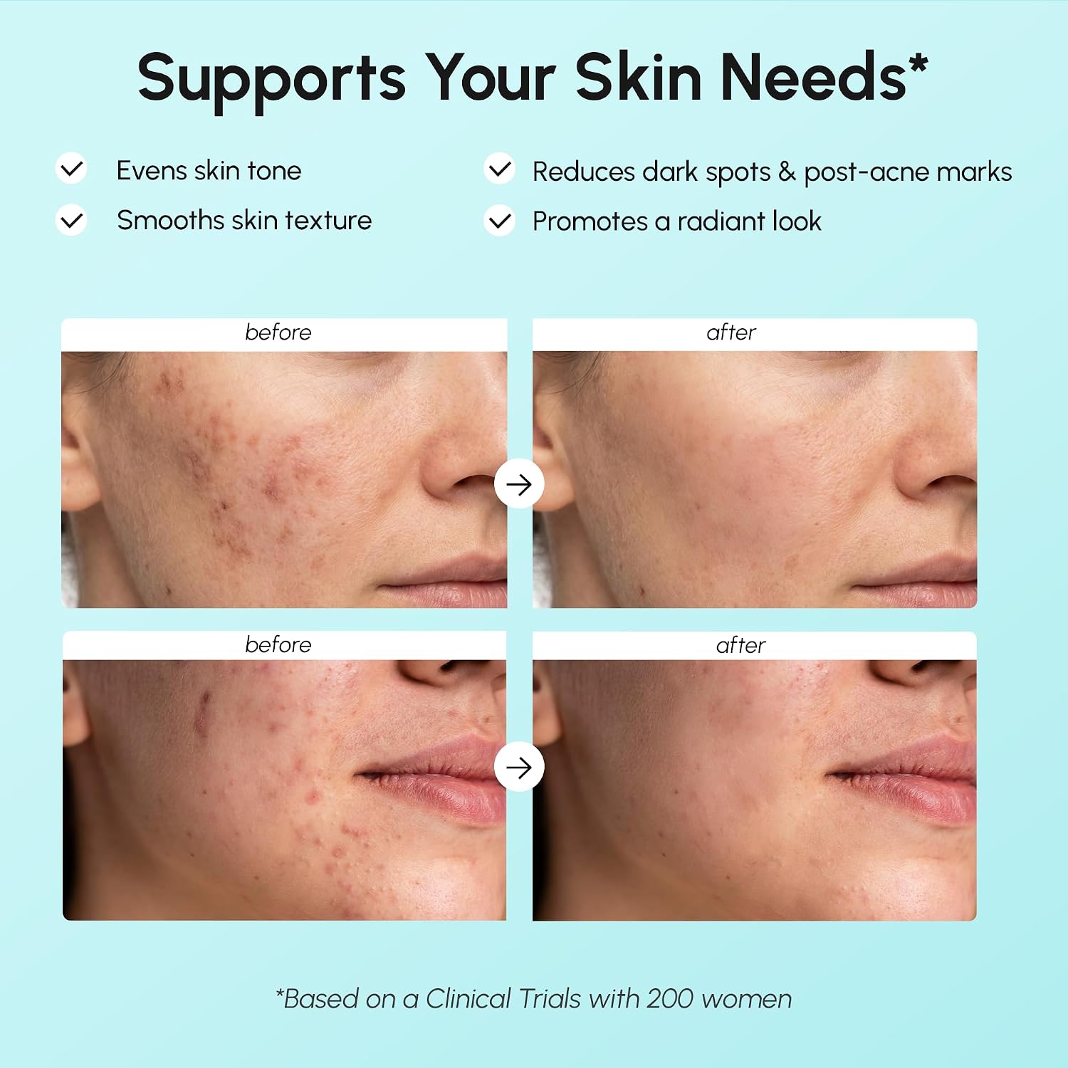 Thumbnail 2 de MAREE Azelaic Acid 15% Face Cream with Niacinamide & Salicylic Acid for Dark Spots, Redness, and Acne-Prone Skin