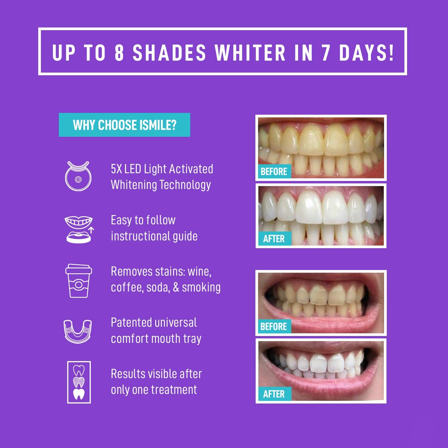 Thumbnail 1 de iSmile Teeth Whitening Kit 35% Carbamide Peroxide