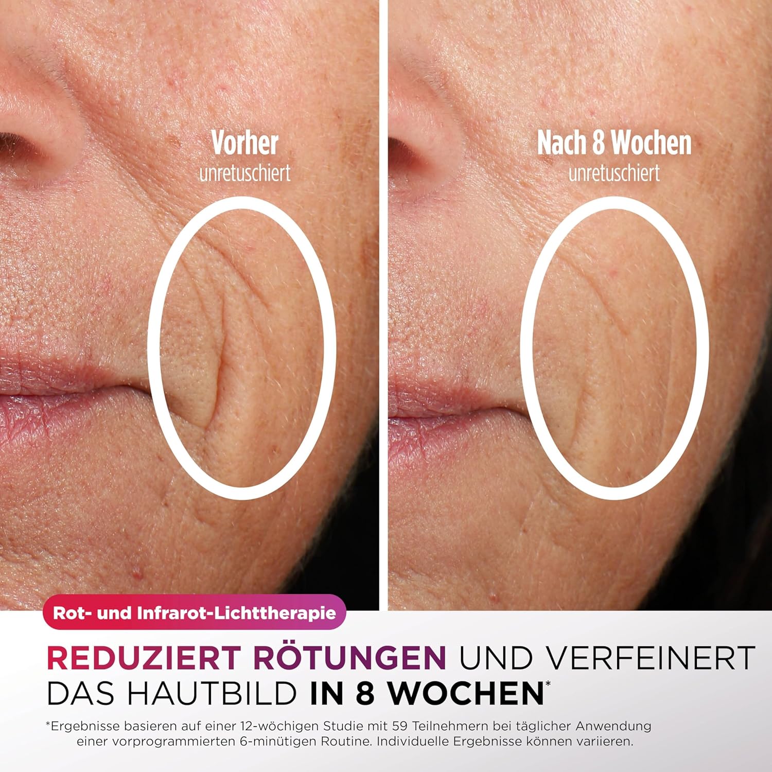 Detalle 2 de Shark CryoGlow LED Maske – LED-Lichttherapie mit Kühlung der Augenpartie (Kühles Lila, FW312EUPL)