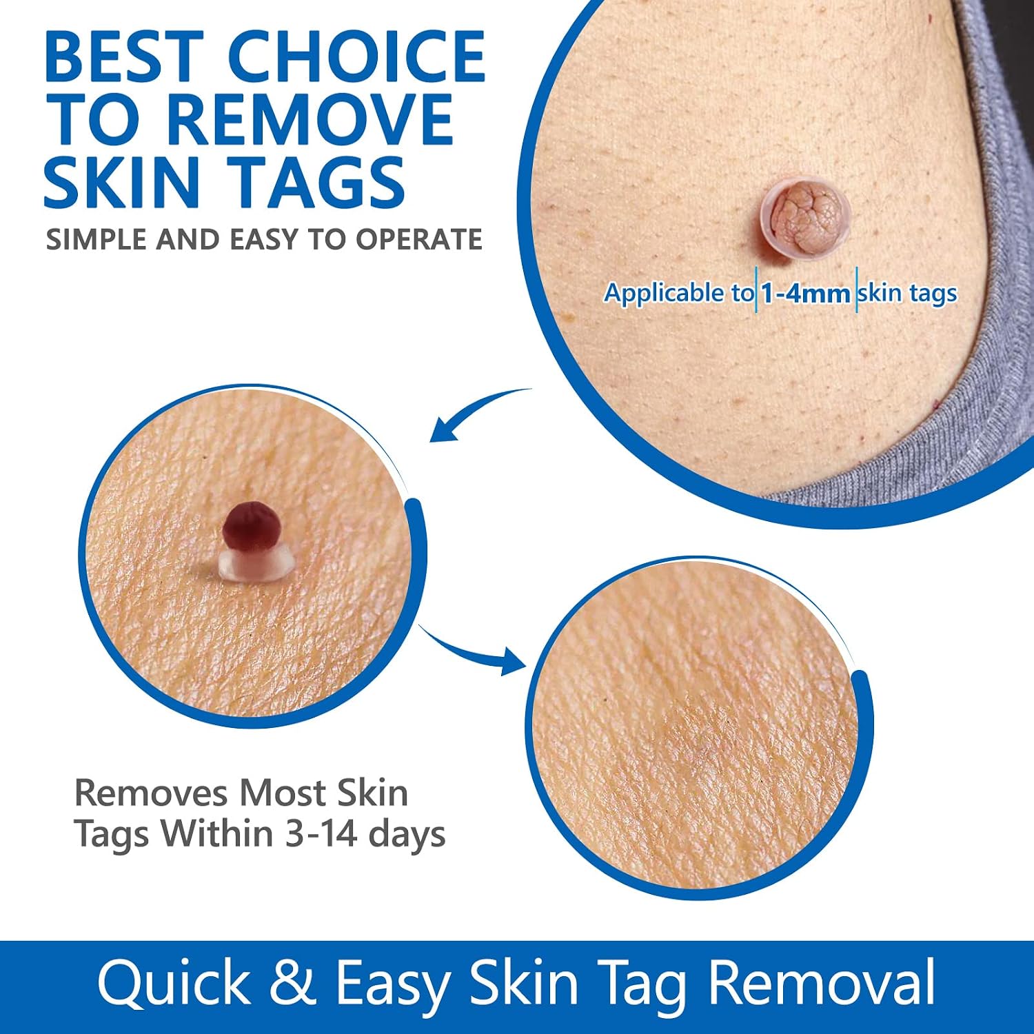 Thumbnail 2 de Skin Tag Removal Kit for All Skin Types