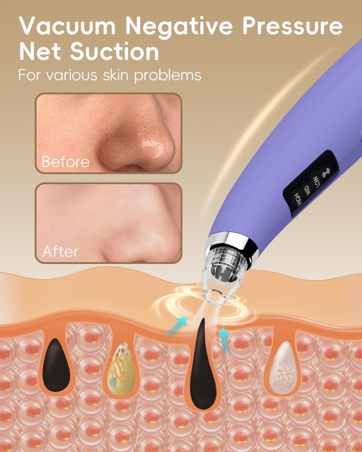 Thumbnail 1 de Pore Vacuum Blackhead Remover - Pore Extractor with 5 Attachments & 3 Suction Levels (Purple)