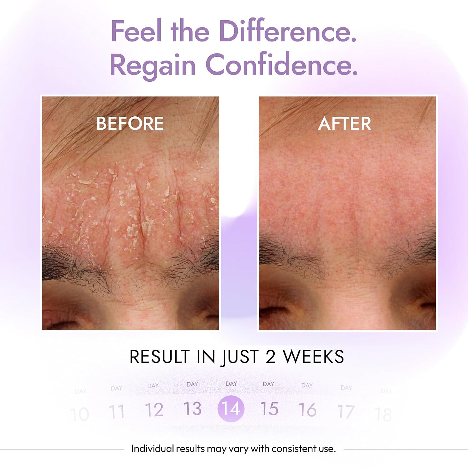 Thumbnail 4 de DERMAdoctor 2% Pyrithione Zinc Tranquility Cleanser: A Multi-Use, Over-the-Counter Solution for Seborrheic Dermatitis and Dandruff