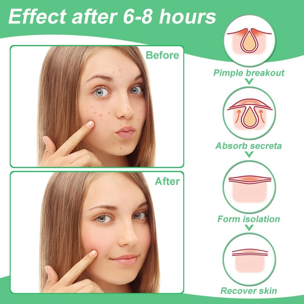 Thumbnail 3 de Zebrlan 300 Stück Pimple Patches 300 Stück