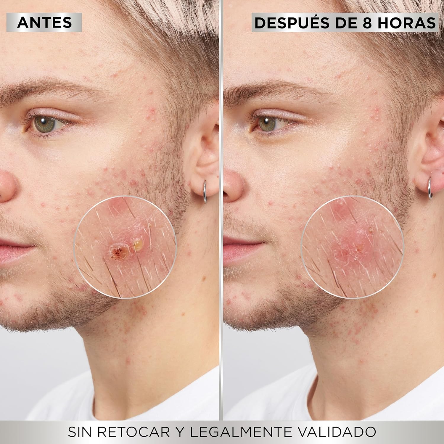 Thumbnail 5 de Garnier Pure Active Parche Visible Anti-Granitos 💧 88u