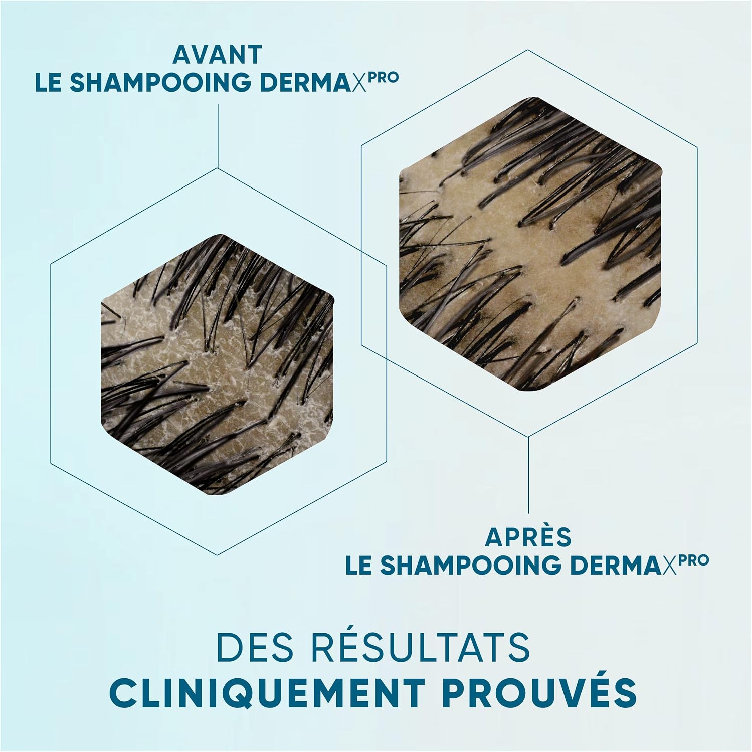 Thumbnail 6 de Head & Shoulders DermaXPro shampoing antipelliculaire 250 ml