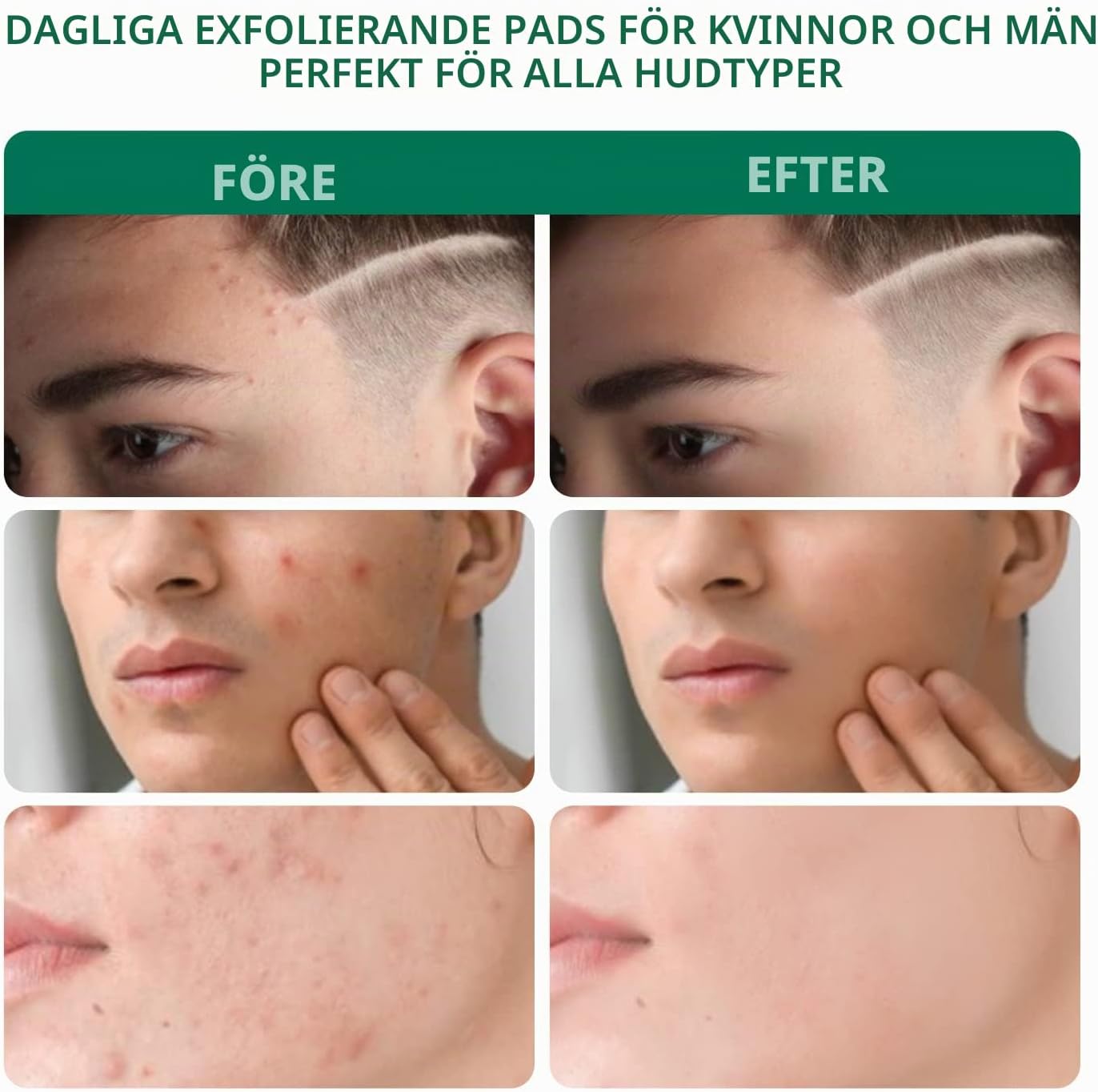 Thumbnail 3 de ANAiRUi Salicylsyrakuddar 2 % – exfolierande ansiktskuddar, 80 st