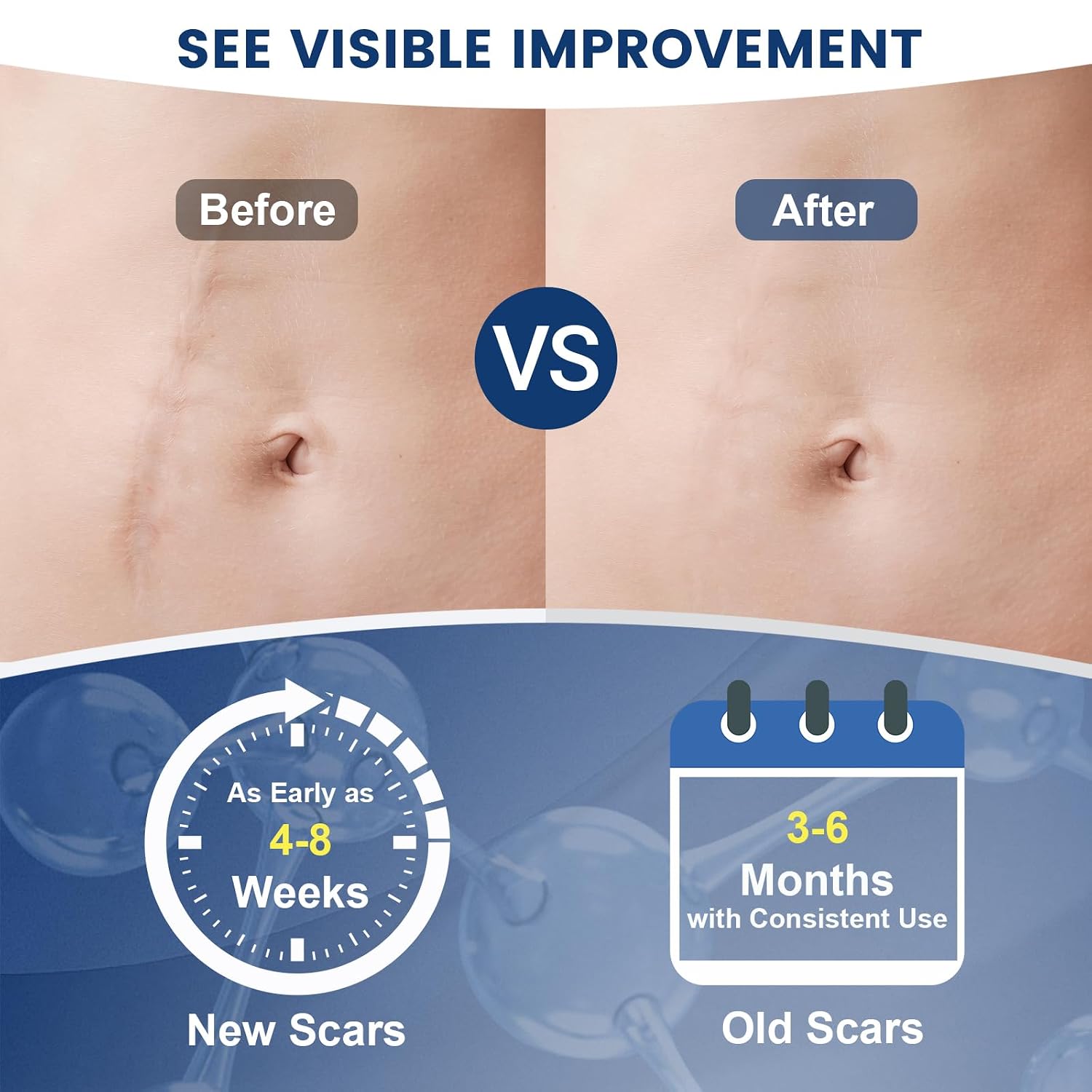 Thumbnail 3 de Rvlaim 100% Silicone Scar Gel Scar Cream (Advanced Silicone Gel) 1.7 oz/50 ml