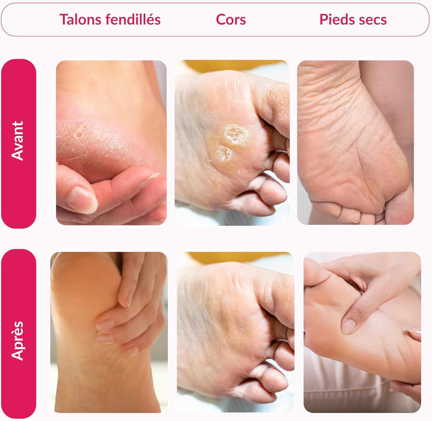 Thumbnail 6 de Summer Foot masque premium pour les pieds – élimine callosités et laisse les pieds doux
