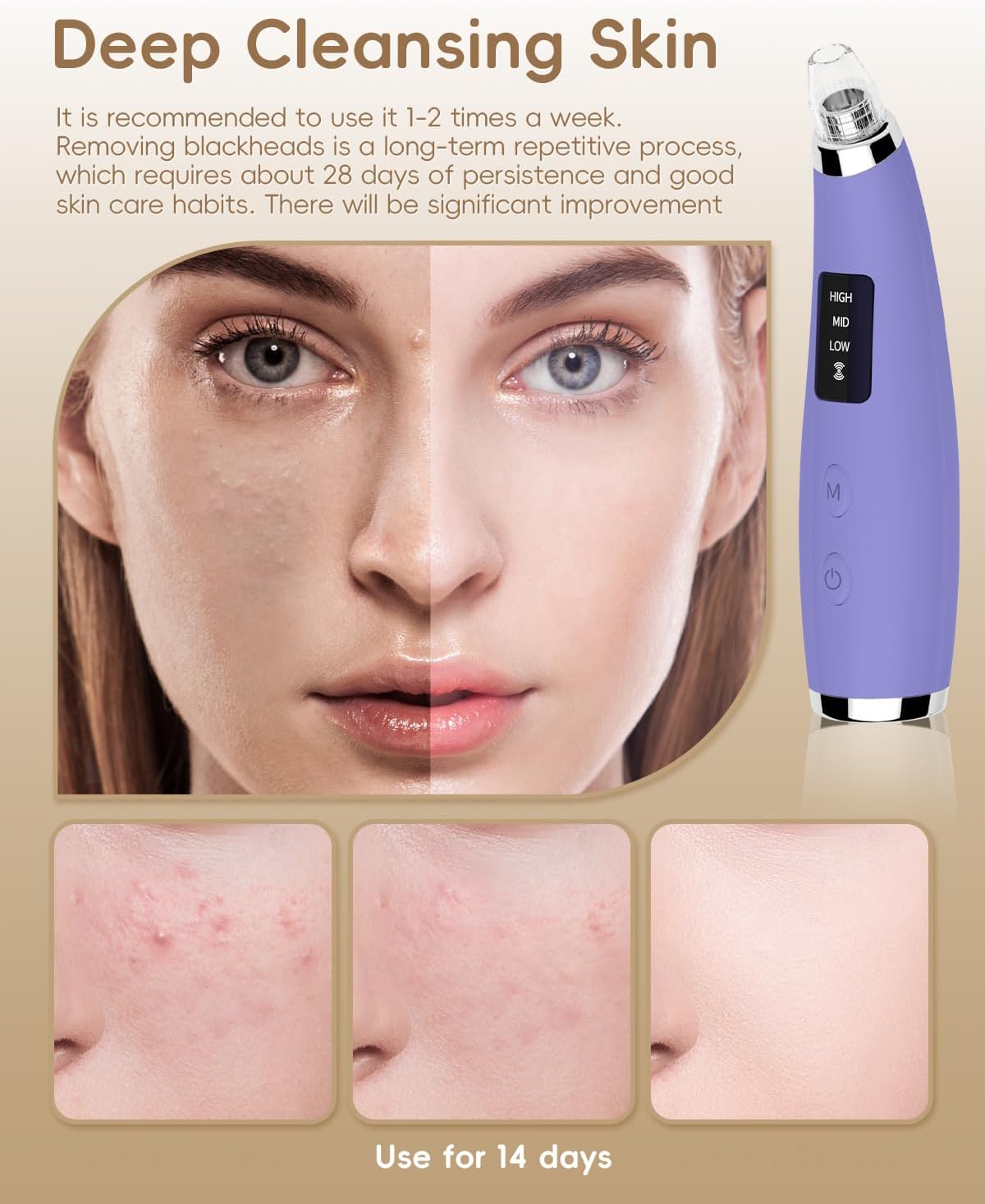 Thumbnail 2 de Pore Vacuum Blackhead Remover - Pore Extractor with 5 Attachments & 3 Suction Levels (Purple)