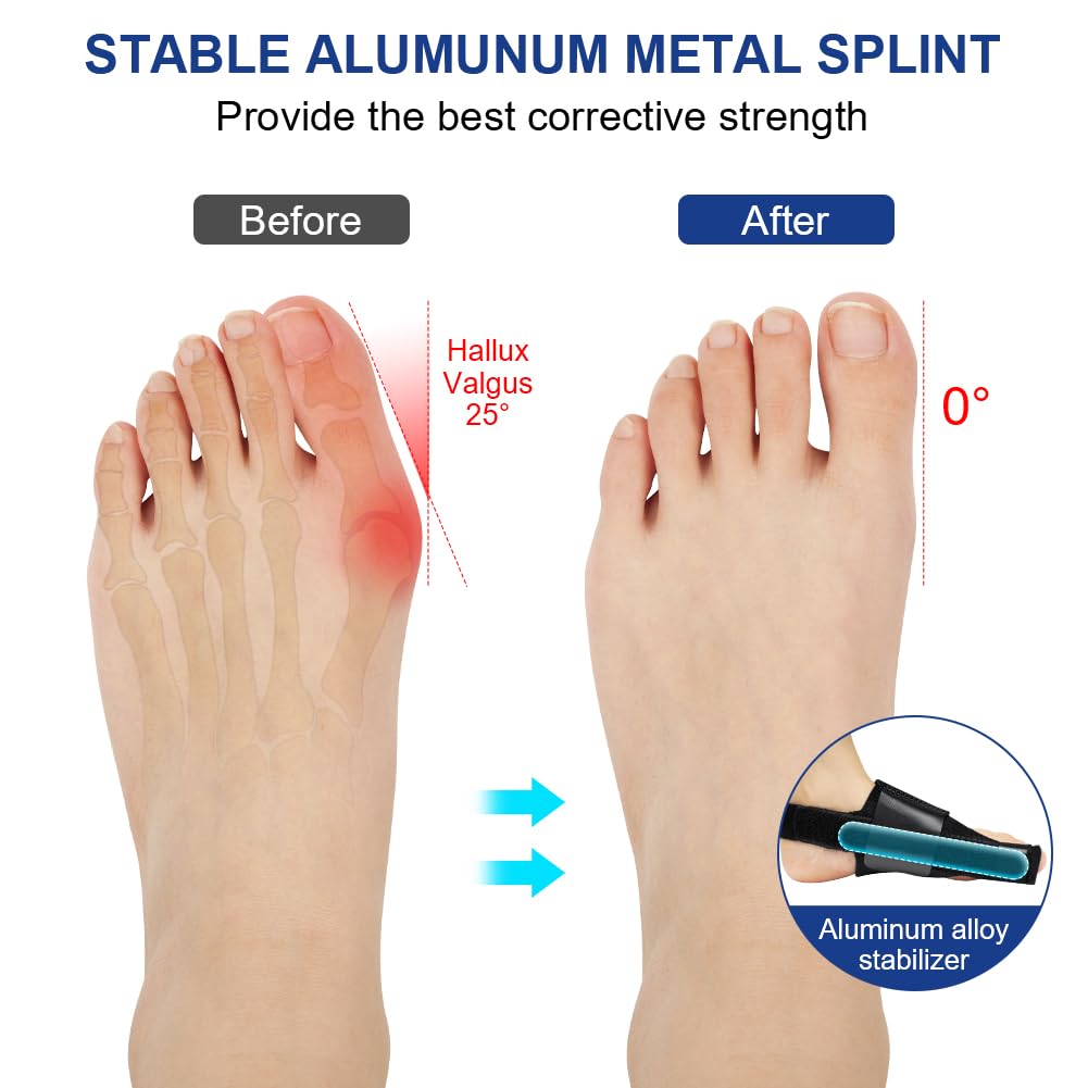Detalle 2 de ACWOO 4062627 hallux-valgusset met verstelbare spalken en gelteenstrekkers