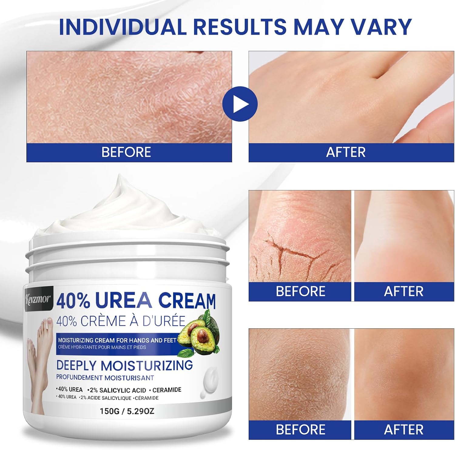 Thumbnail 3 de Kevzmor Urea Foot Cream, 150 g with Avocado Butter and Tea Tree Oil