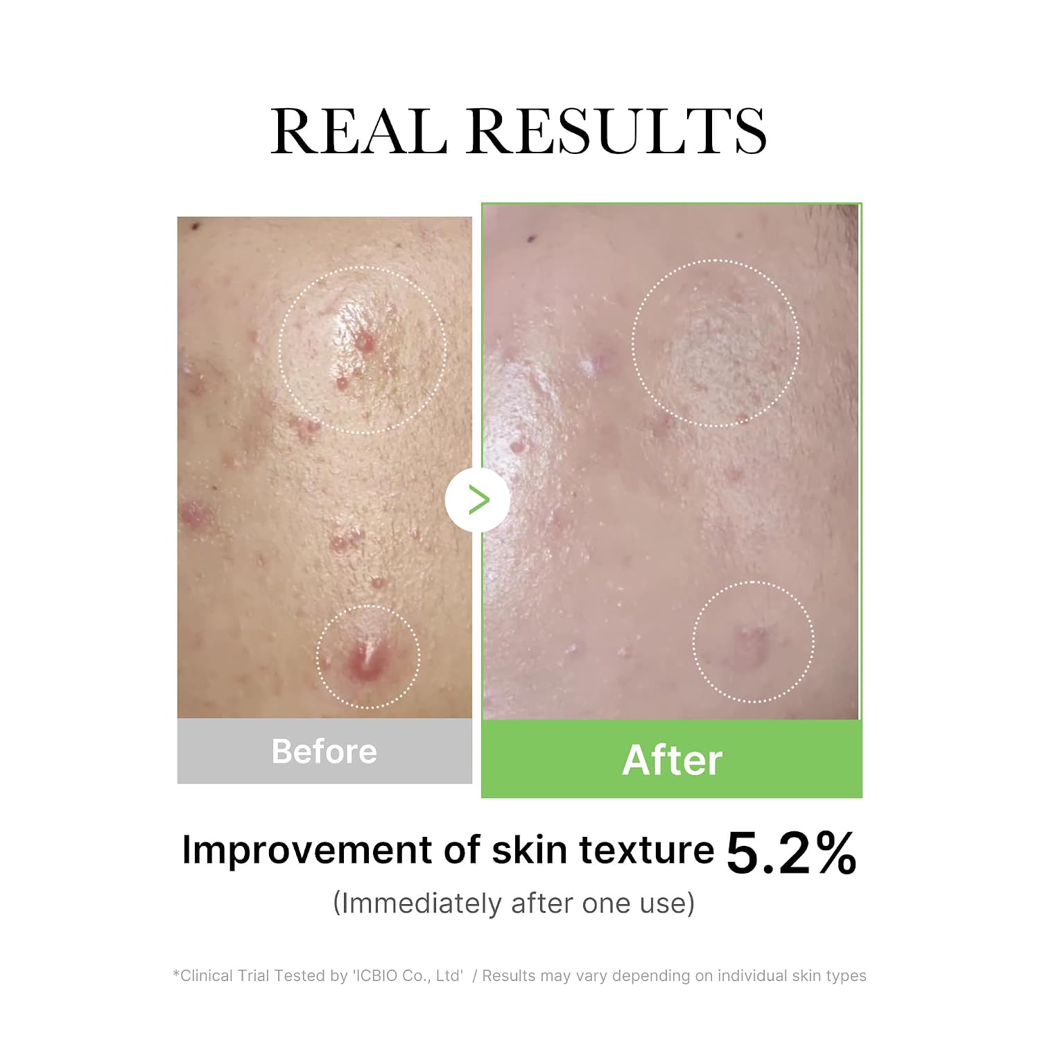 Detalle de medicube Exosome Cica Tea Tree Ampoule – beruhigendes Serum für empfindliche Haut, 30 ml