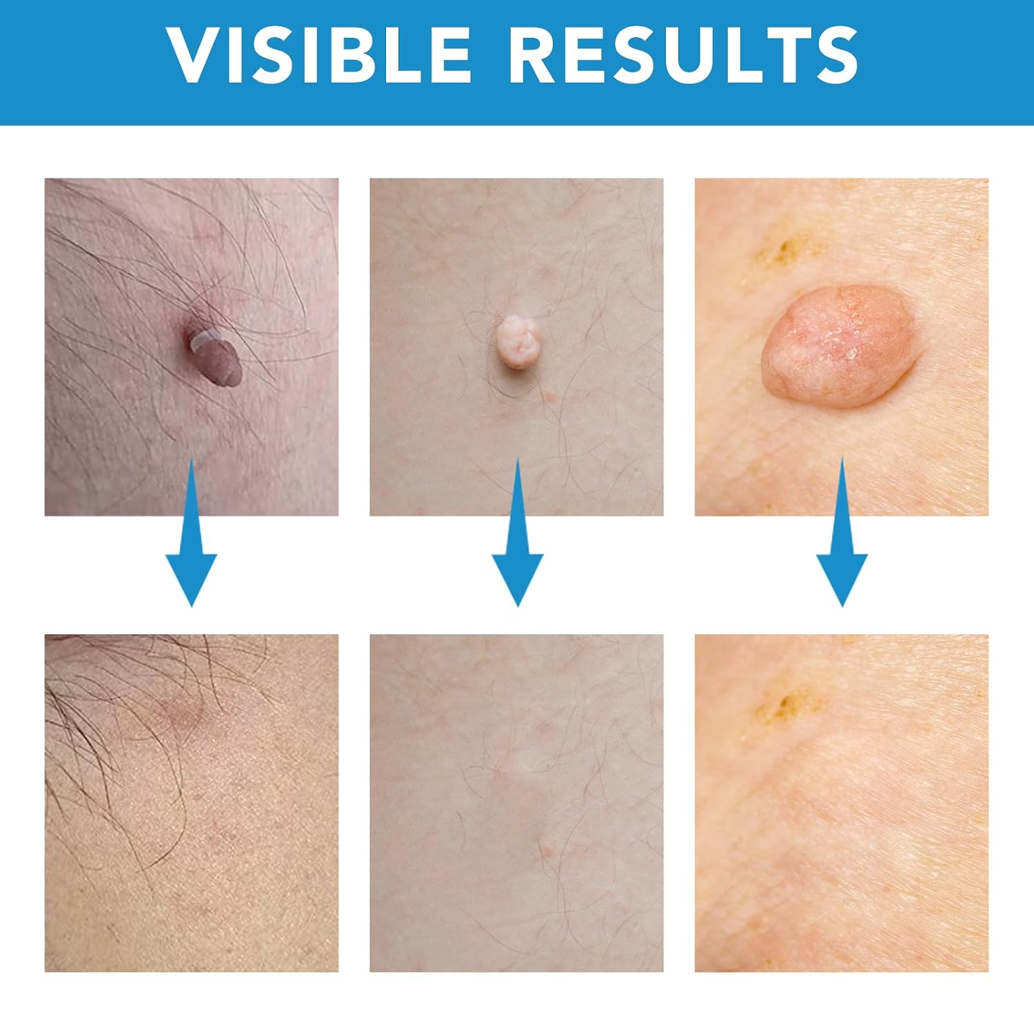 Detalle 2 de Zyloqj Auto Skin Tag Remover Kit zur Selbstentfernung von Hautmarken (2-in-1-Pen, Gummibänder & Reinigungstücher)