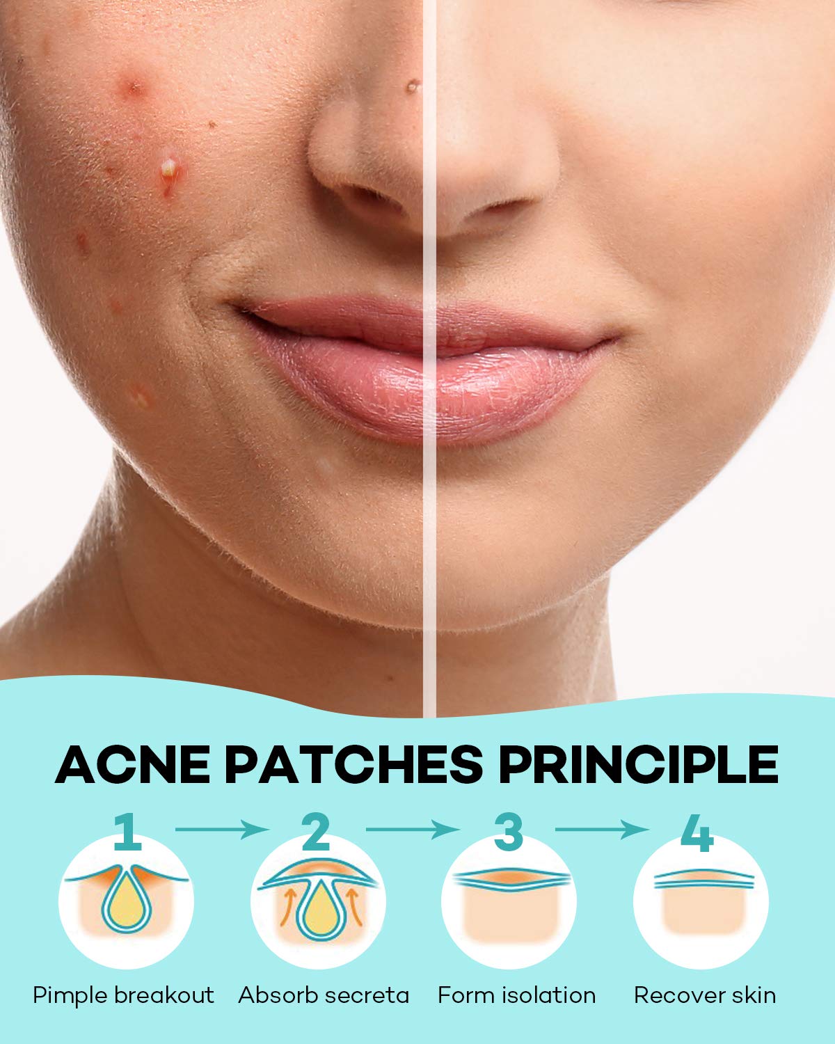 Thumbnail 5 de TKTK Pimple Patch Acne Patch 140-pack