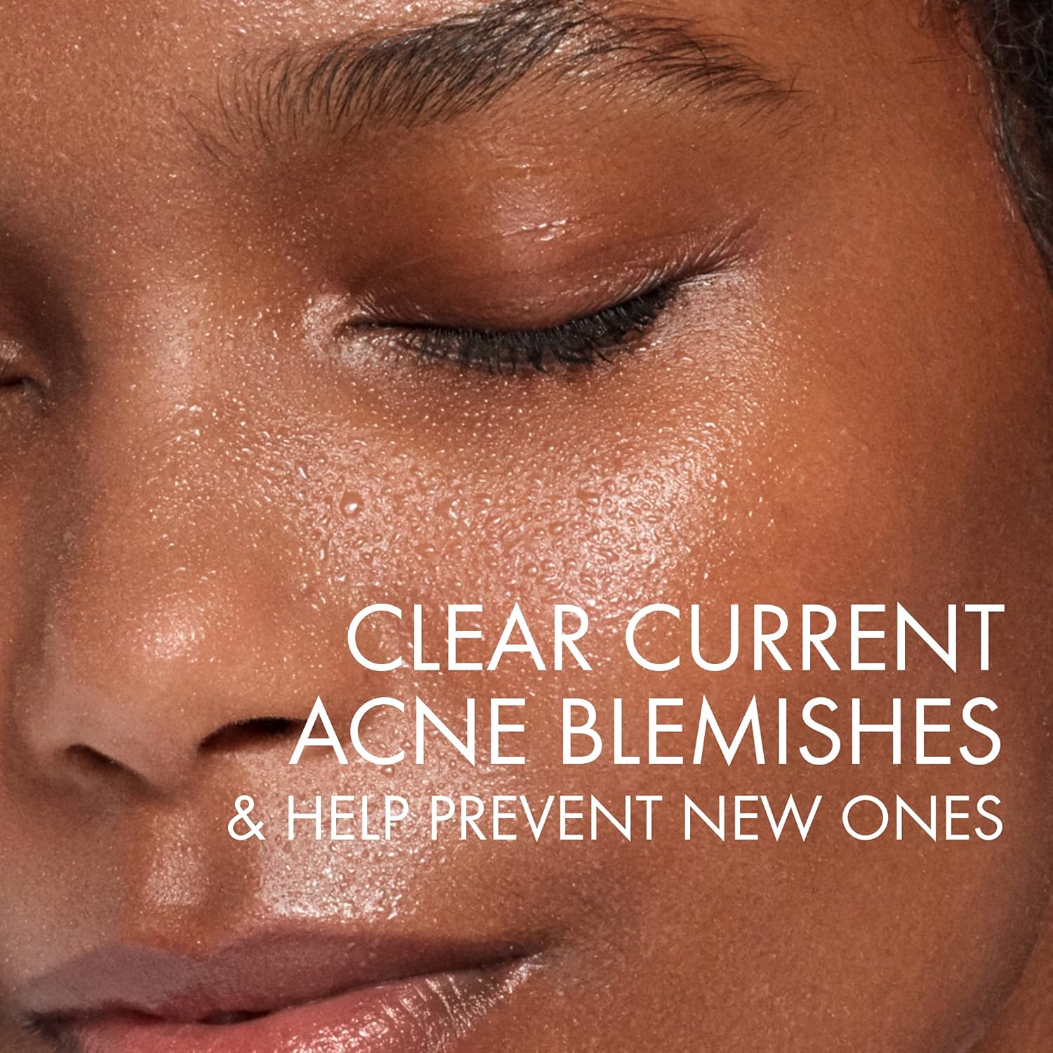 Thumbnail 2 de Vichy Normaderm Intensive Purifying Cleanser for Blemish‑Prone Skin (200ml)