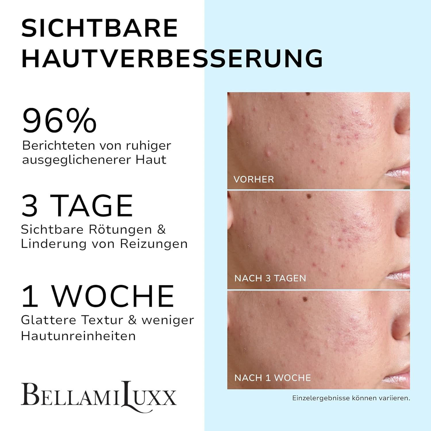 Detalle 2 de BellamiLuxx Akne Creme Hautpflege