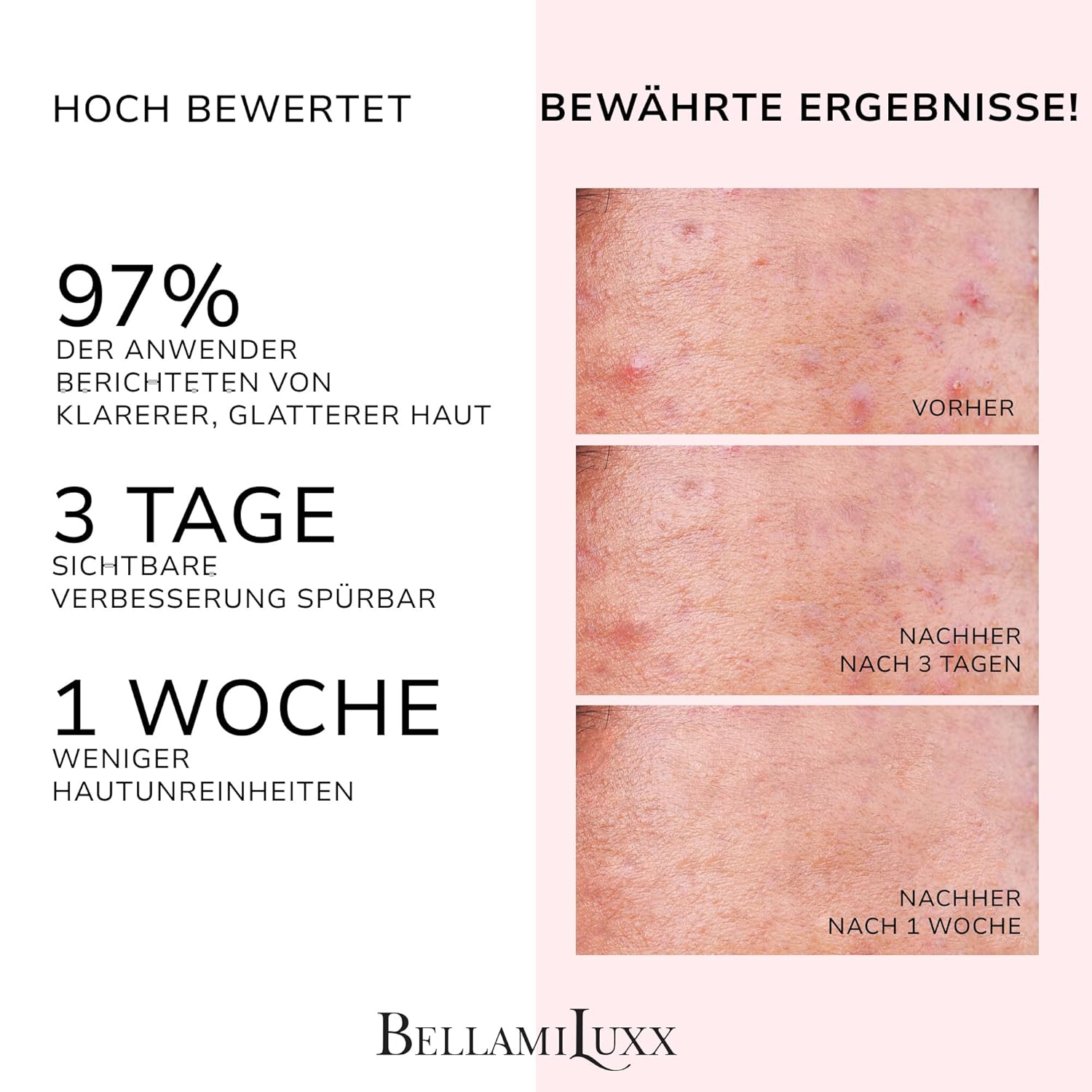 Thumbnail 1 de BellamiLuxx Pickel Creme 2% Salicylsäure