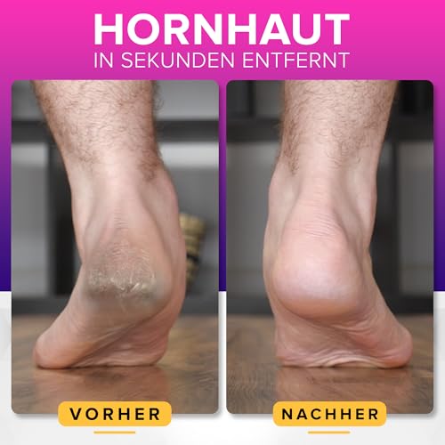 Detalle 2 de NYK1 ULTIMATIVE Hornhautfeile Hornhautentferner für Fußpflege • Groß