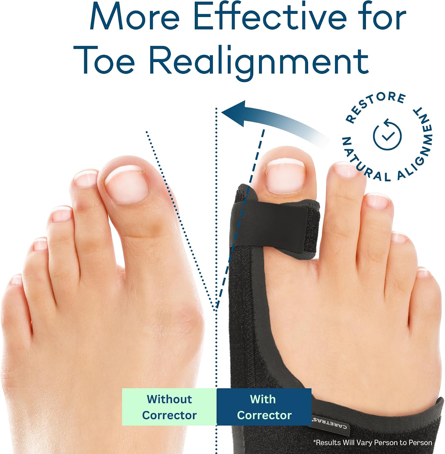 Detalle 2 de Caretras 2-Pack Bunion Corrector: Adjustable Day/Night Orthopedic Toe Support