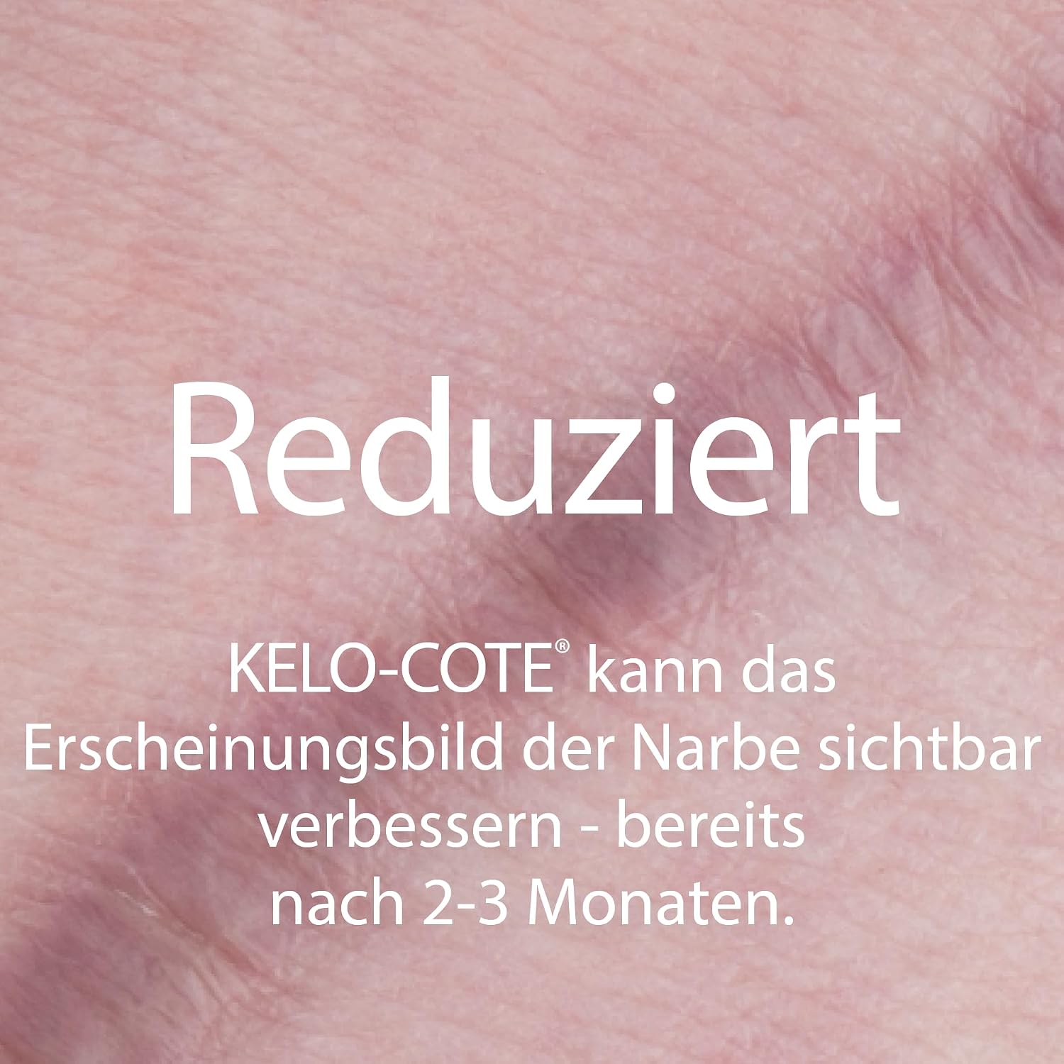 Detalle de KELO-COTE UV SPF30 Silikon-Narben-Gel 15 g – Schutz und Glättung für Narben