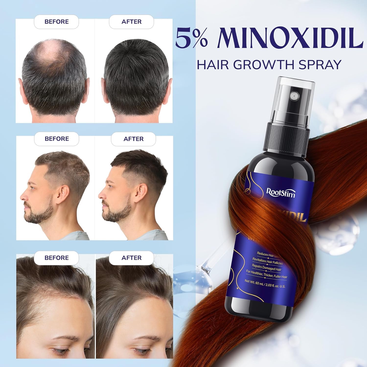 Detalle de 5% Minoxidil Hair Growth Hair Loss Treatment Serum (2-Pack) with Rosemary – Extra Strength, for Men & Women