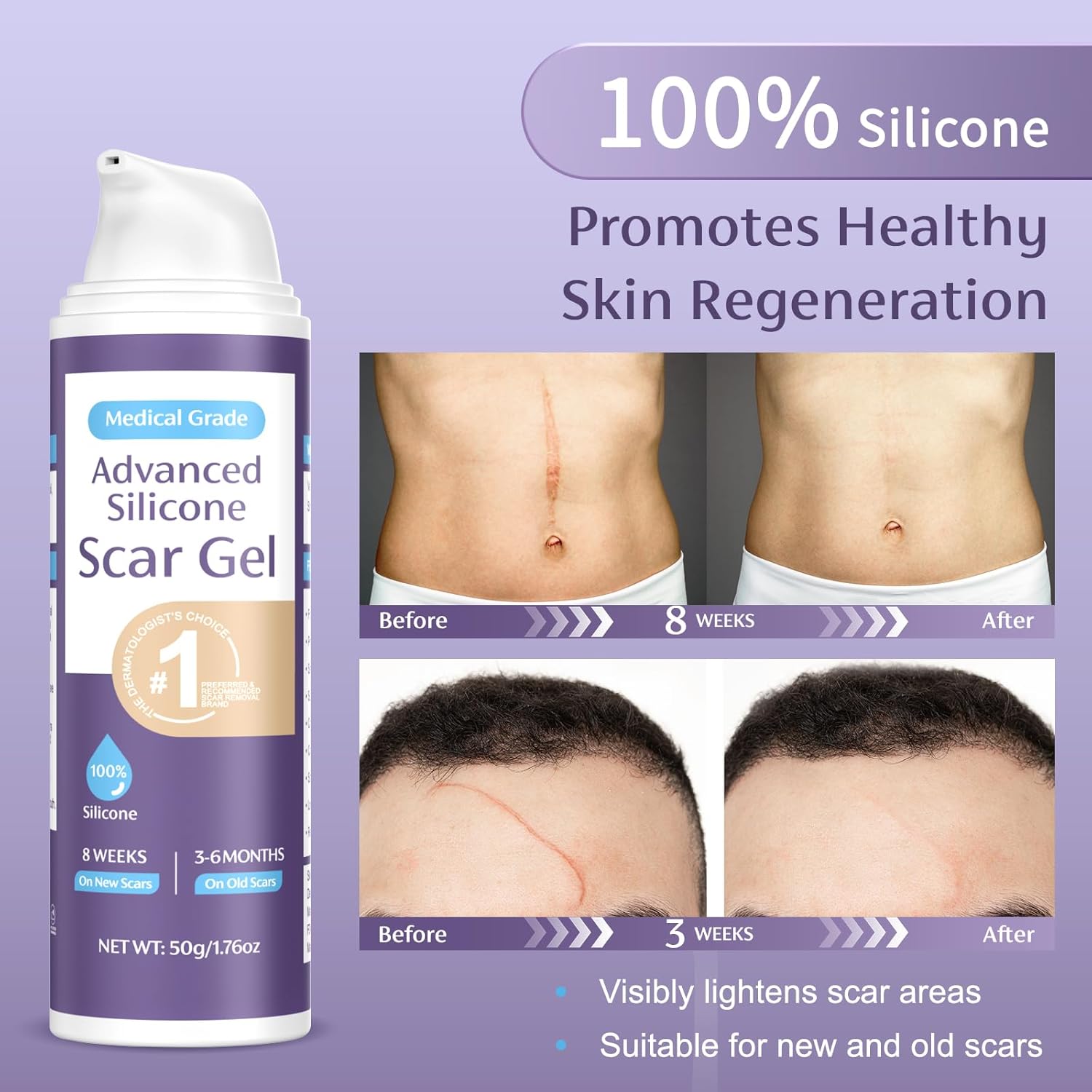 Thumbnail 3 de Skiennix Silicone Scar Gel 50g: A Practical Choice for Scars, Burns and Keloids