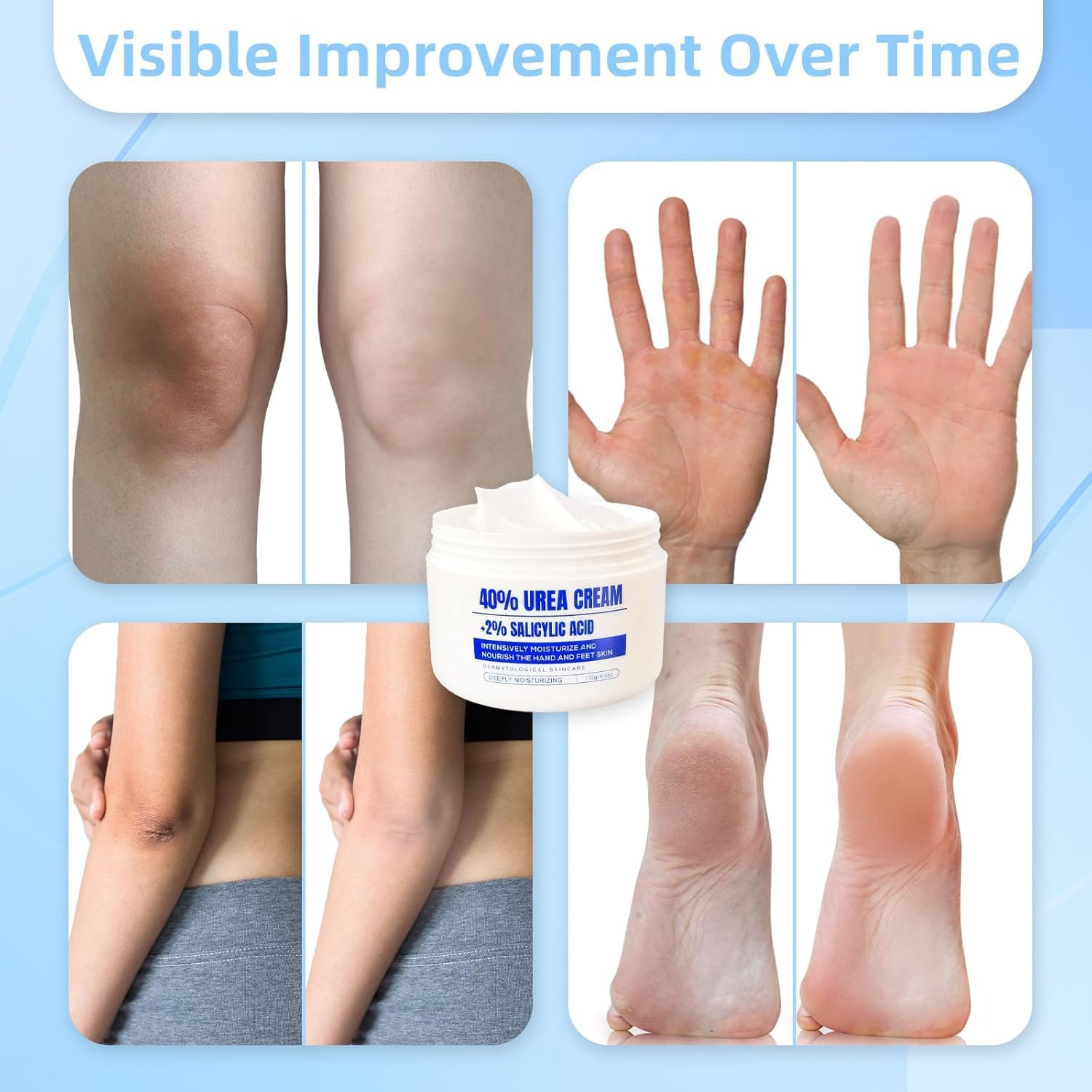 Thumbnail 6 de QQWIAX 40% Urea Cream, 170 g for Dry, Rough Hands and Feet