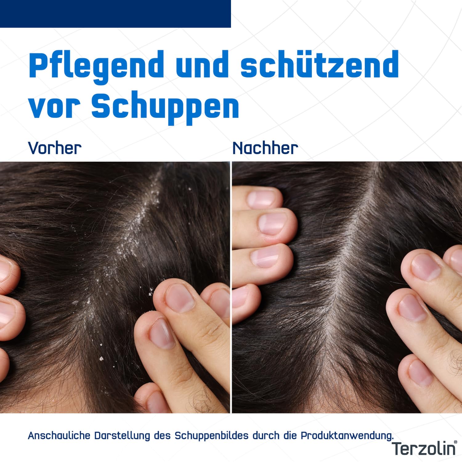Detalle 2 de Terzolin® Expert Schuppen-Shampoo für fettige Kopfhaut mit Juckreiz & Schuppen – 200 ml