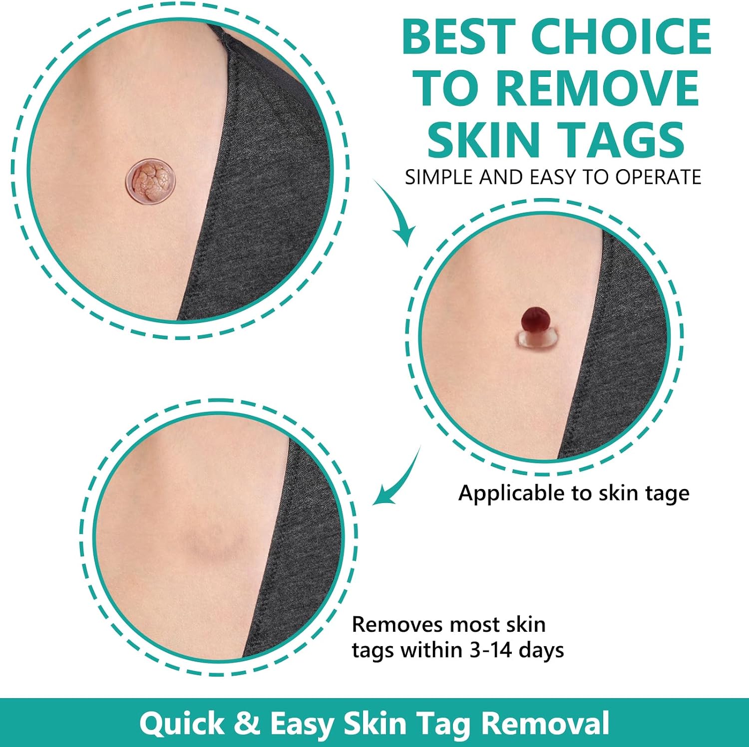 Thumbnail 1 de FLETUTE Skin Tag Removal Kit: Gentle CryoTag Device