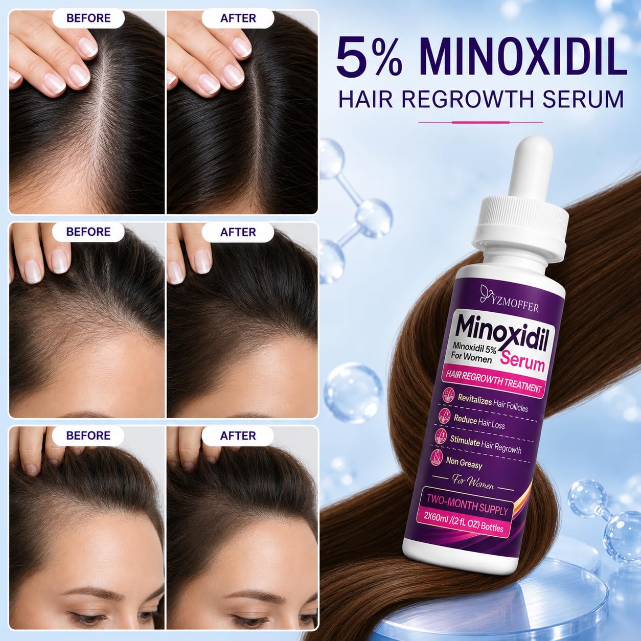 Detalle de Yzmoffer 5% Minoxidil Hair Regrowth Treatment for Women, 2-Bottle Set