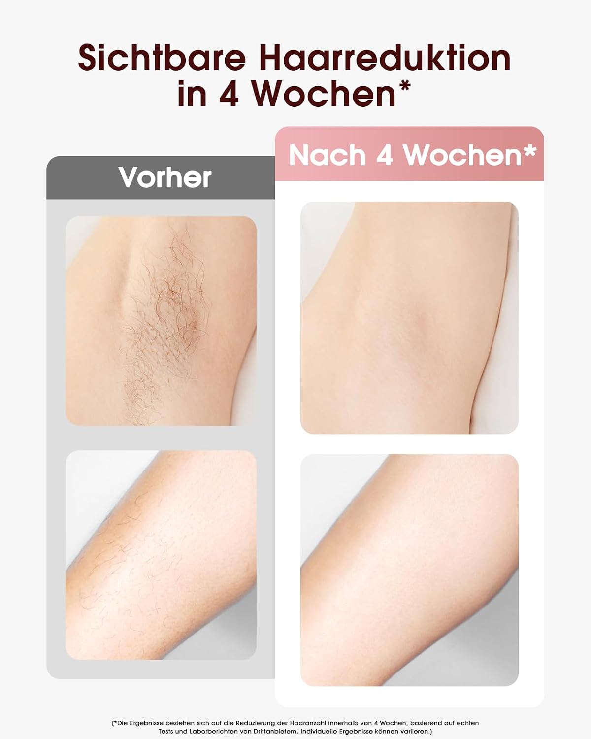 Thumbnail 2 de Haarlosy IPL Gerät zur Haarentfernung mit Kühlfunktion – 999,900 Lichtimpulse, 5 Energiestufen, für Damen und Herren