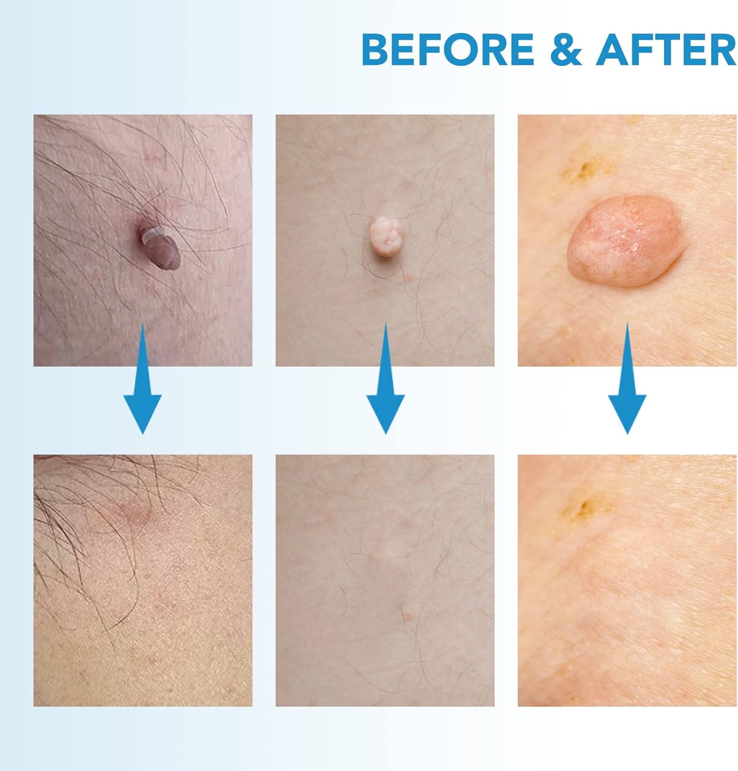 Thumbnail 5 de Skin Tag Removal Kit 40 bands 🩺
