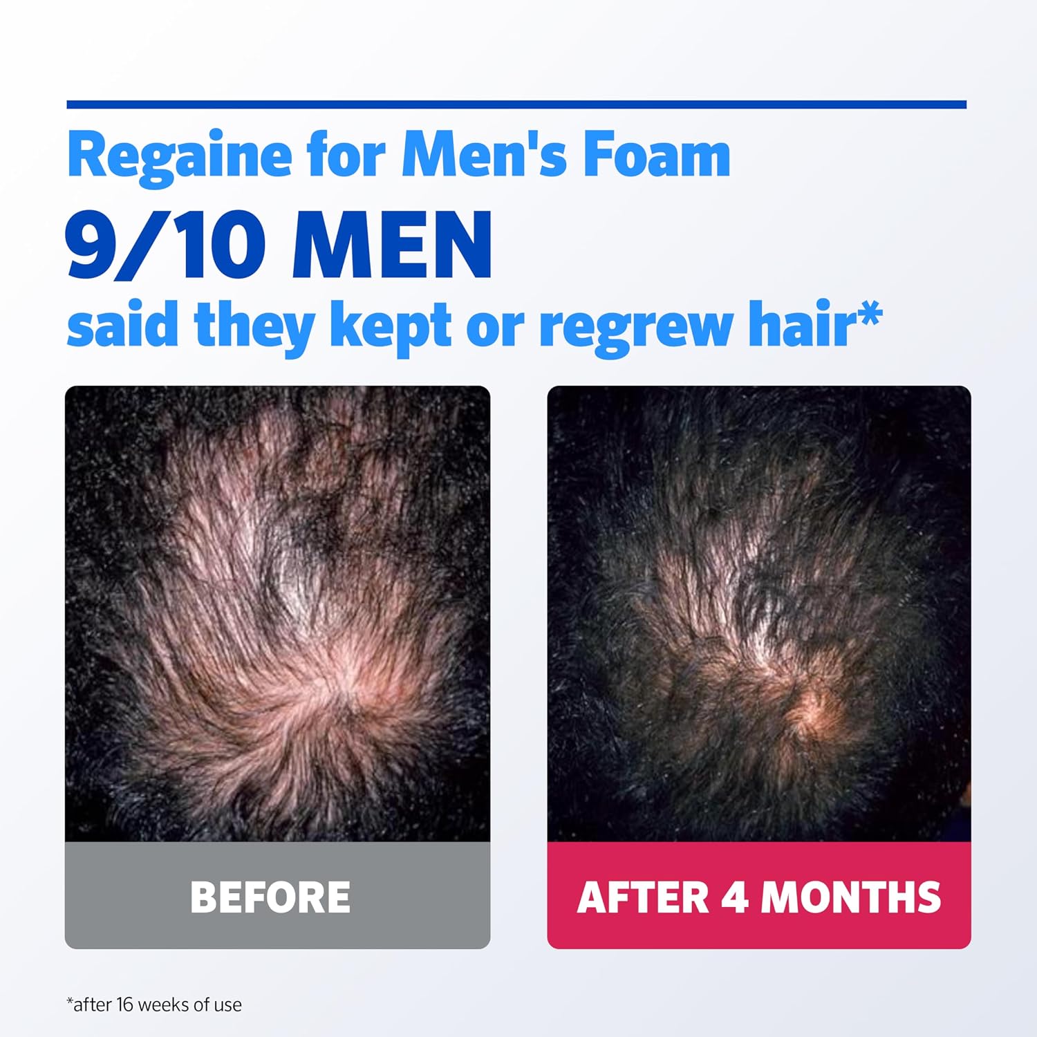 Detalle de Regaine For Men Extra Strength Foam: 5% Minoxidil for Hair Regrowth (3x73ml)
