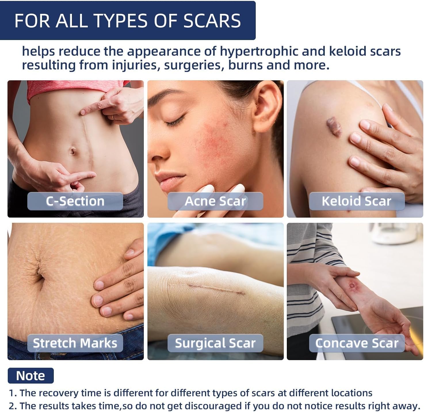 Detalle 2 de URAY Silicone Scar Gel, 30 g, 100% Silicone for Old and New Scars