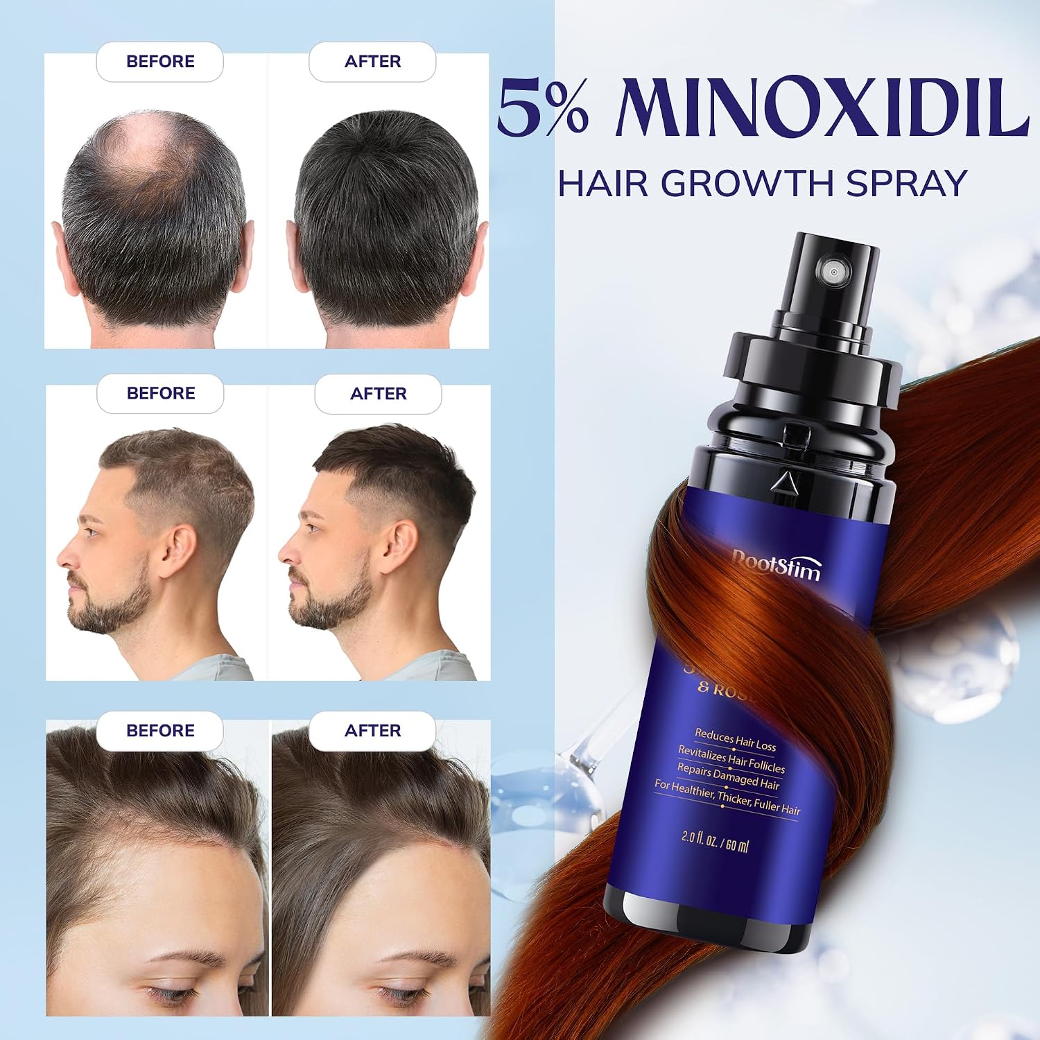 Thumbnail 3 de RootStim Minoxidil Hair Growth Treatment 180 mL