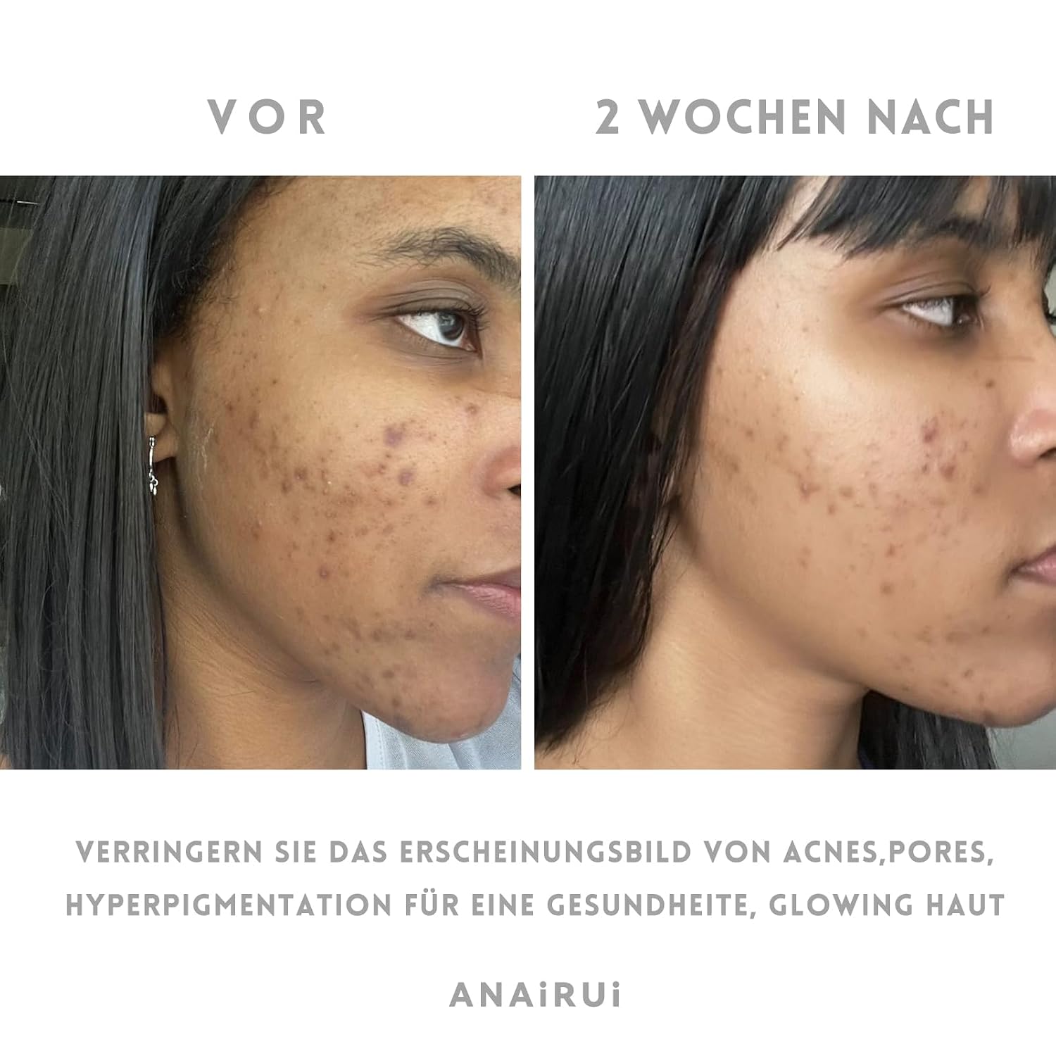 Thumbnail 3 de ANAiRUi Kurkuma Vitamin C Tonmaske für das Gesicht (120 g) – reinigt, beruhigt und unterstützt bei ungleichmäßigem Hautton