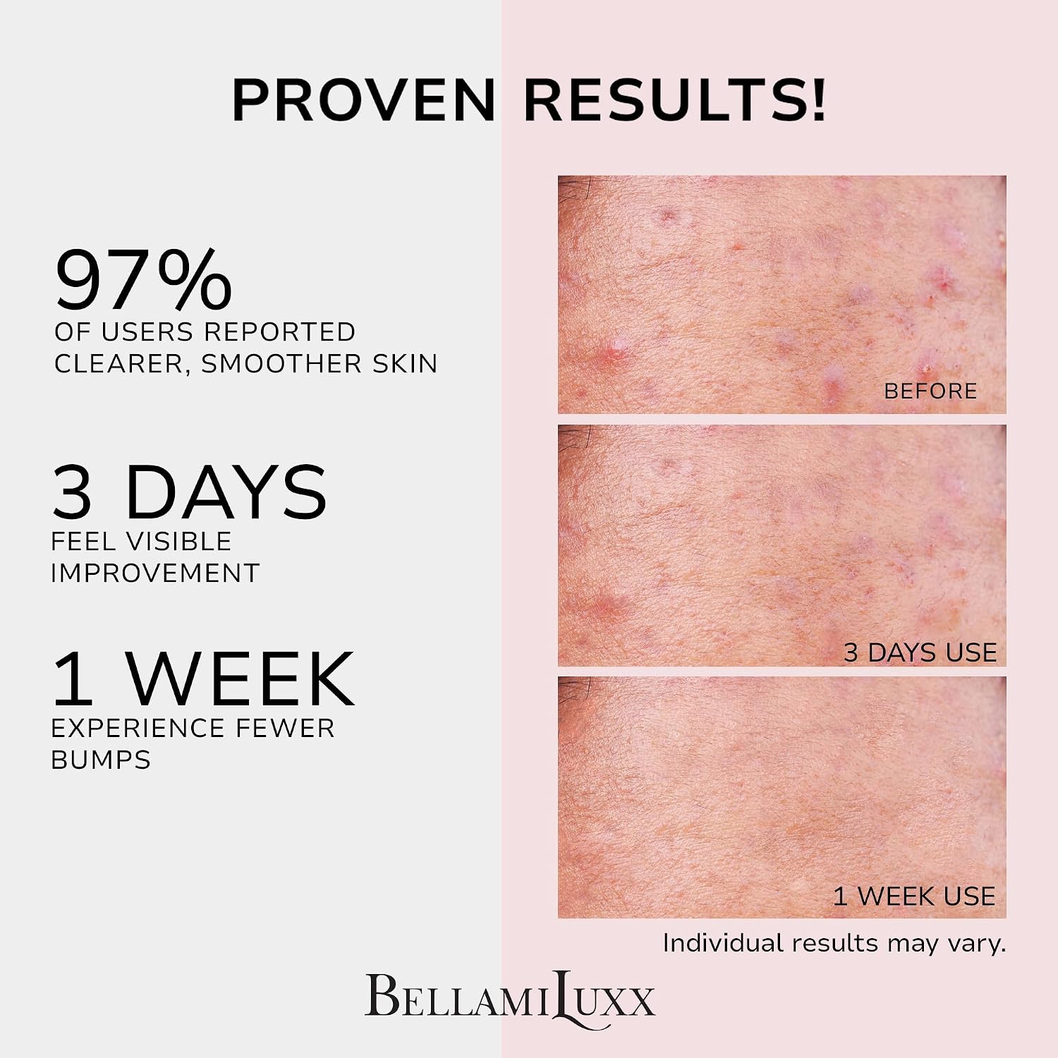Detalle 2 de BellamiLuxx Butt Acne Clearing Cream