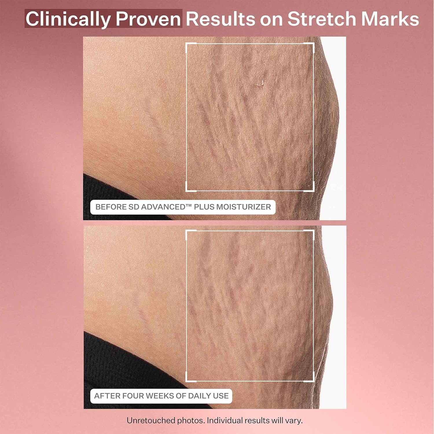 Thumbnail 6 de StriVectin SD Advanced Plus Intensive Moisturiser for Wrinkles & Stretchmarks