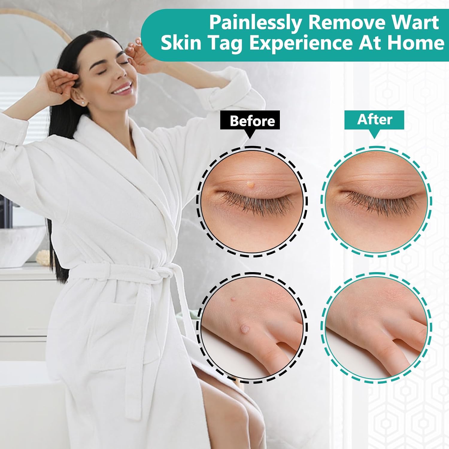 Thumbnail 2 de FLETUTE Skin Tag Removal Kit: Gentle CryoTag Device