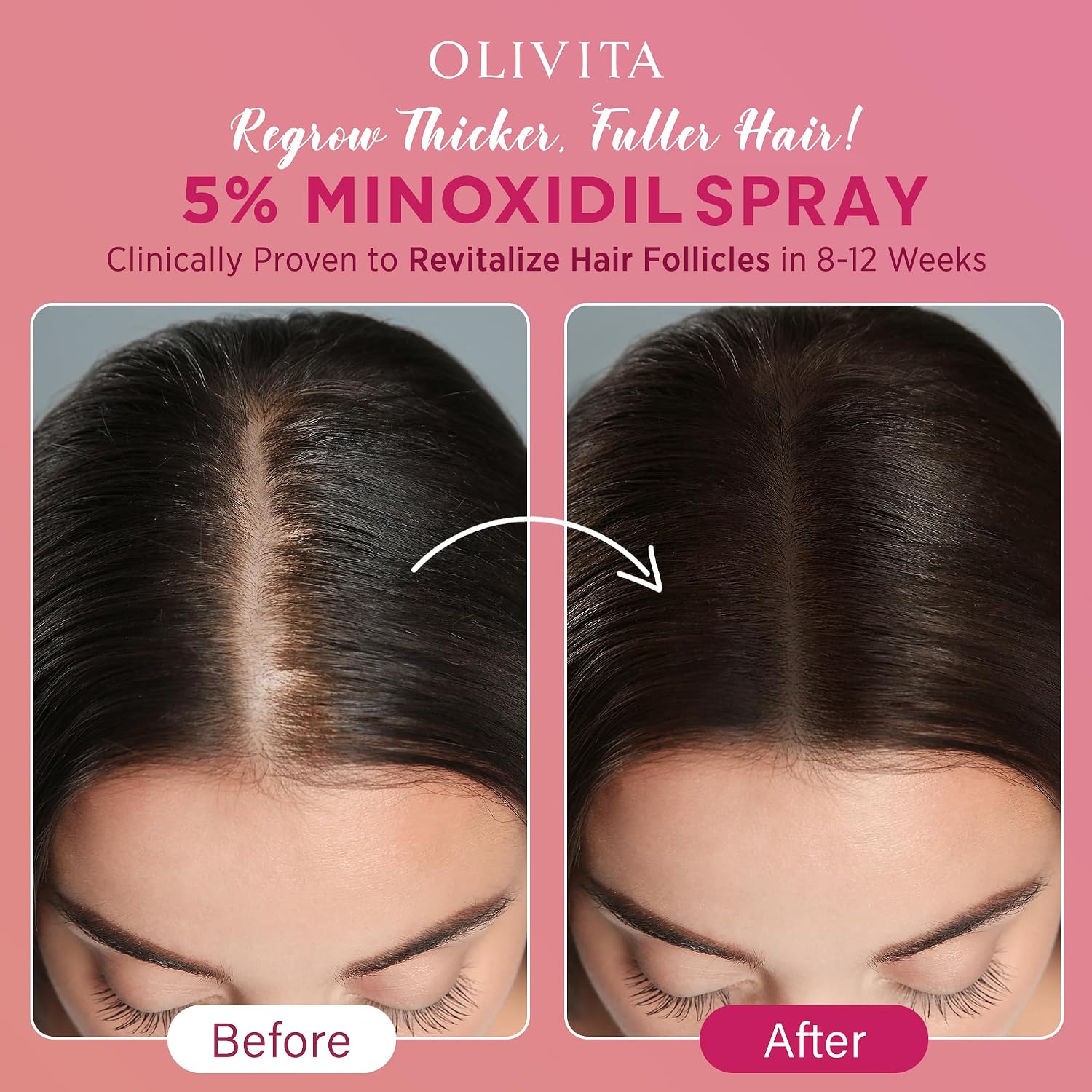 Detalle de 5% Minoxidil Spray for Women Hair Growth (Extra Strength) – Revitalize Hair Follicles & Regrow Thicker Hair, 2 Packs