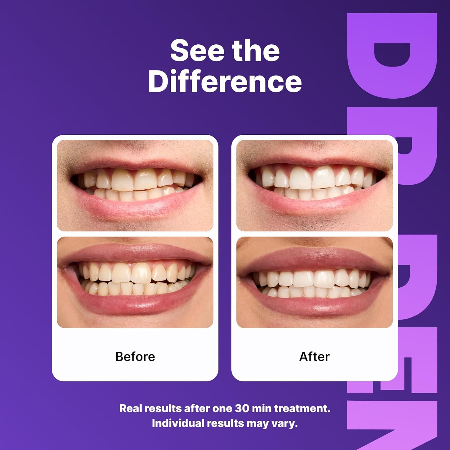 Detalle de DRDENT Purple Strips: No-Peroxide Whitening with PAP for Safe, Everyday Sparkle
