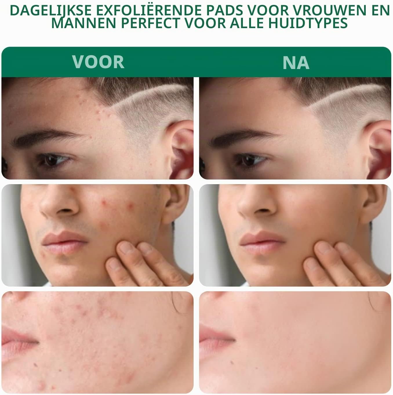 Detalle 2 de ANAiRUi Salicylzuur Gezichtspads, 2% salicylzuur, 80 stuks
