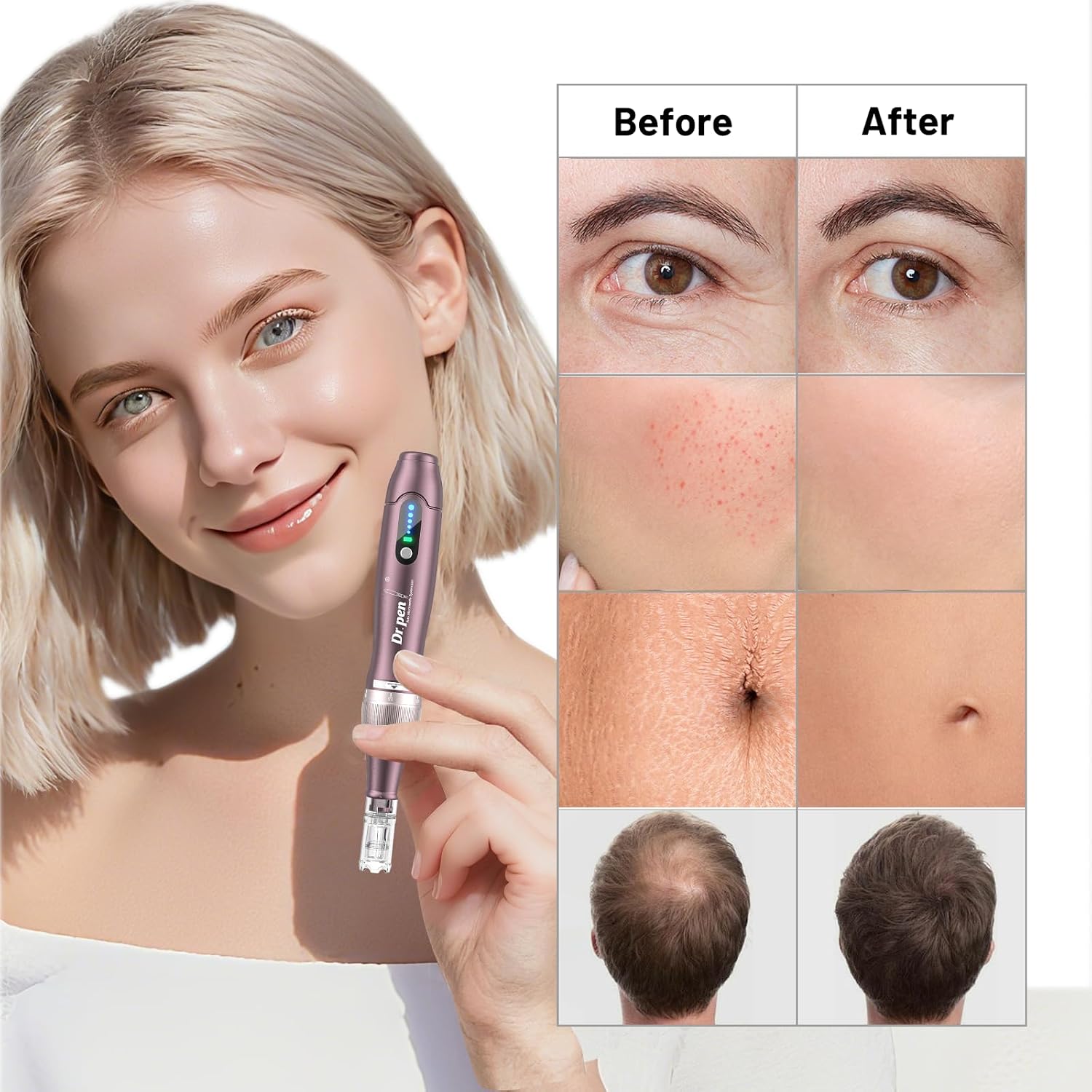 Detalle de Buyounger Dr. Pen 2025 Ultima A10 Professioneller Microneedling Pen (kabellos) mit 25 Ersatzkartuschen