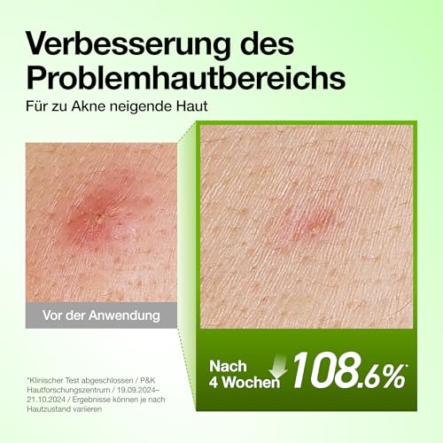 Detalle de ANUA Azelaic Acid 10 Hyaluron Redness Soothing Serum, 1.01oz
