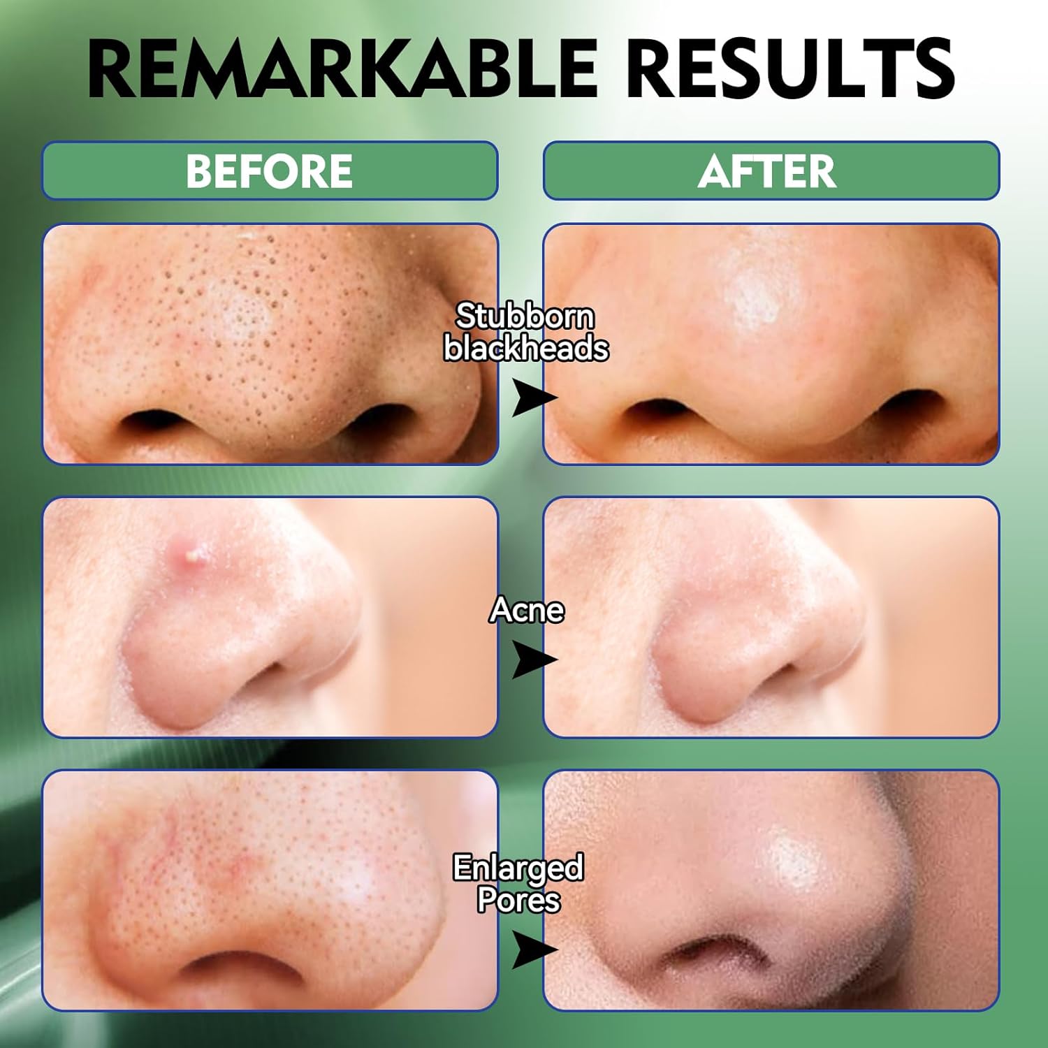 Thumbnail 3 de Eveellyn Mitesserentferner Stripes mit Bambuskohle – 80 Streifen für Nase & Porenreinigung